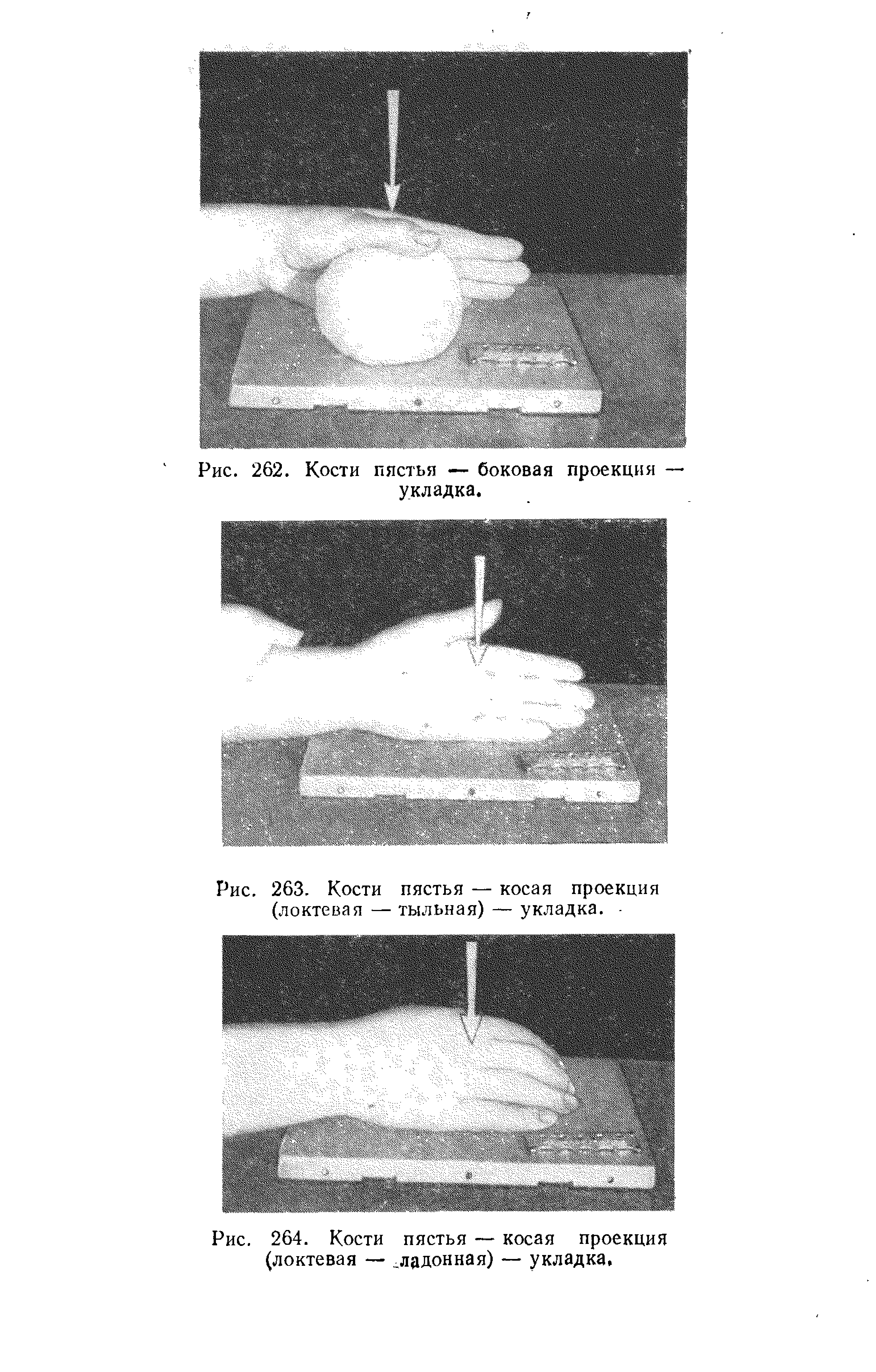 Рис. 263. Кости пястья — косая проекция (локтевая — тыльная) — укладка. -...