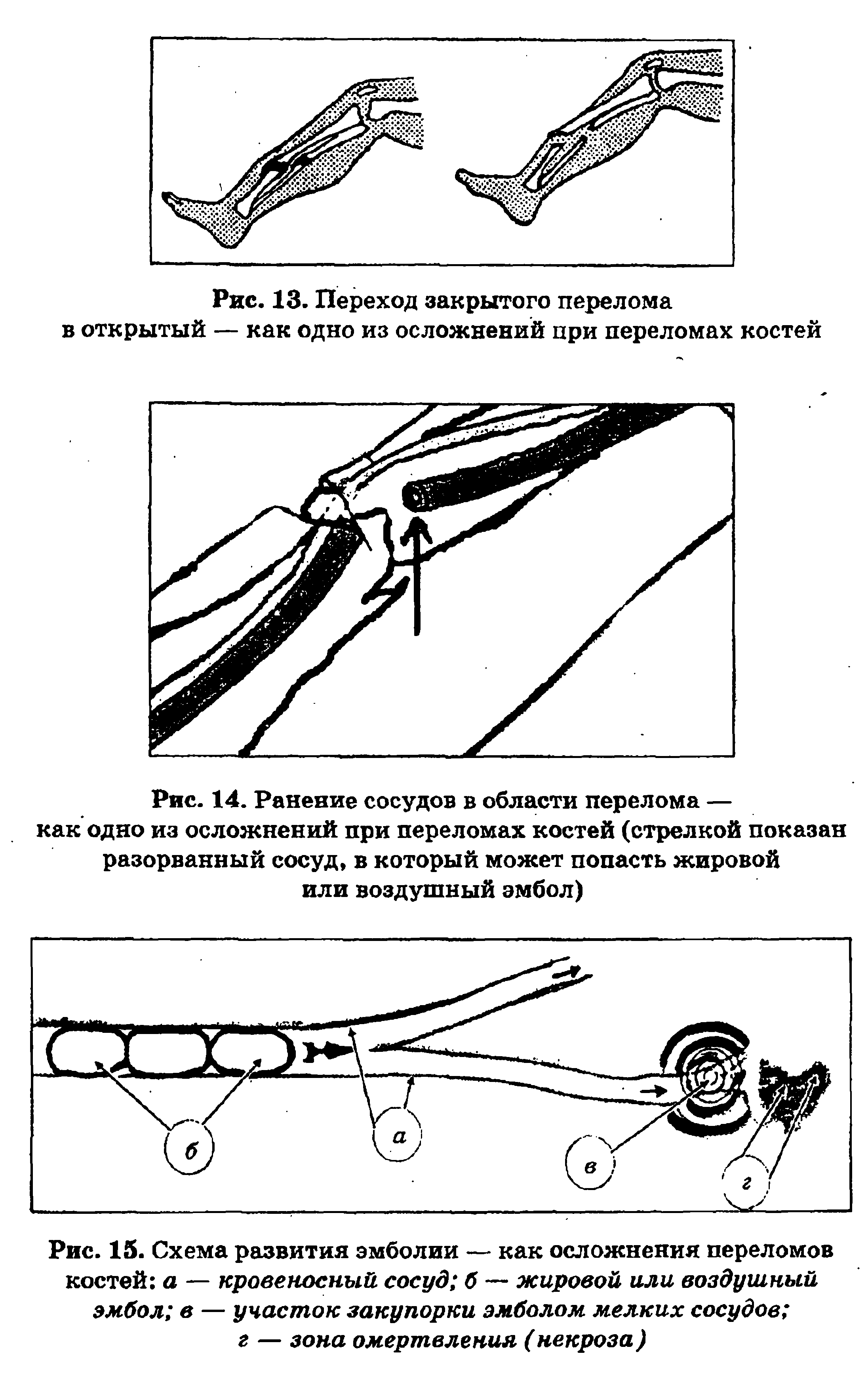 Рис. 14. Ранение сосудов в области перелома — как одно из осложнений при переломах костей (стрелкой показан разорванный сосуд, в который может попасть жировой или воздушный эмбол)...