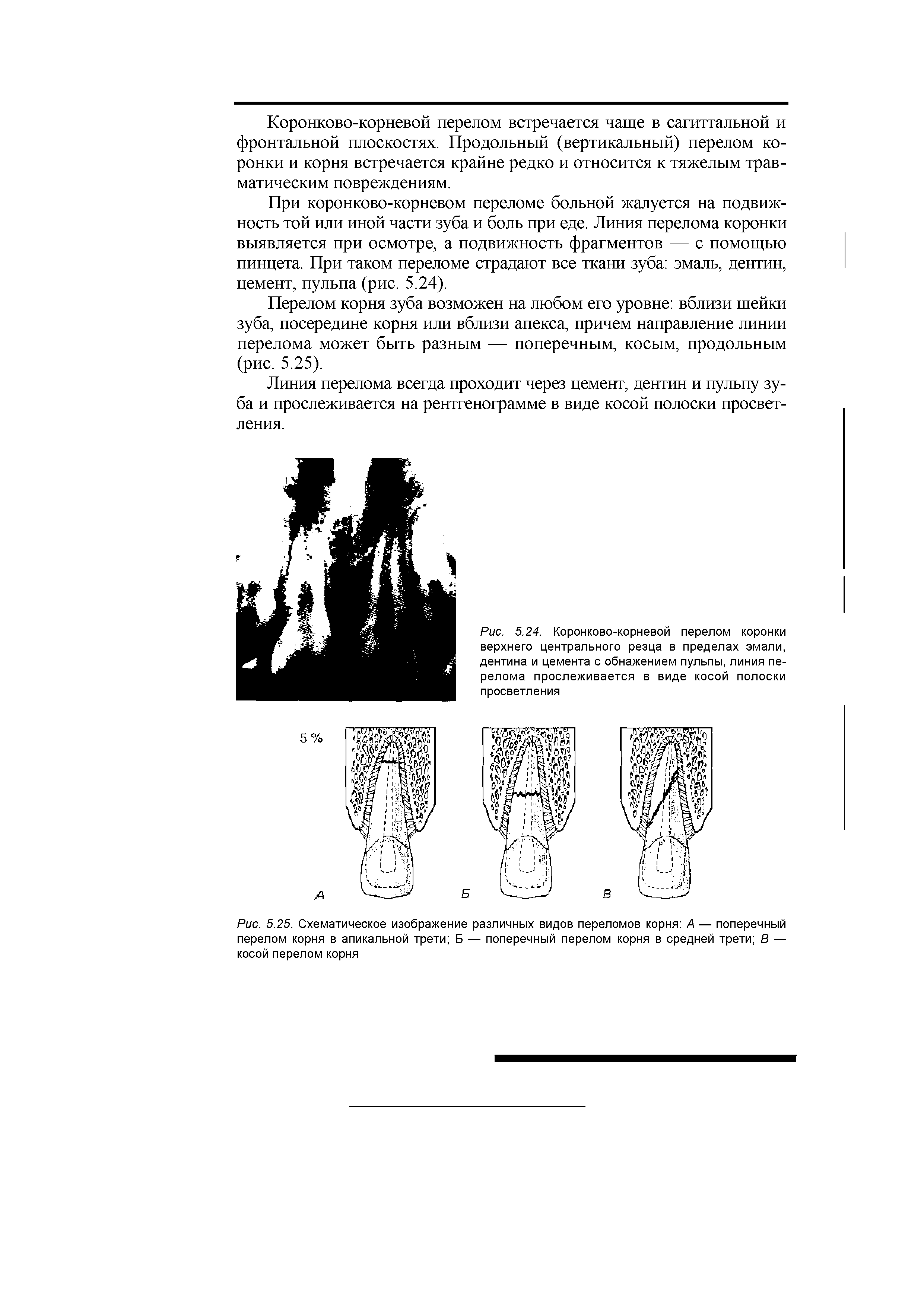 Рис. 5.25. Схематическое изображение различных видов переломов корня А — поперечный перелом корня в апикальной трети Б — поперечный перелом корня в средней трети В — косой перелом корня...