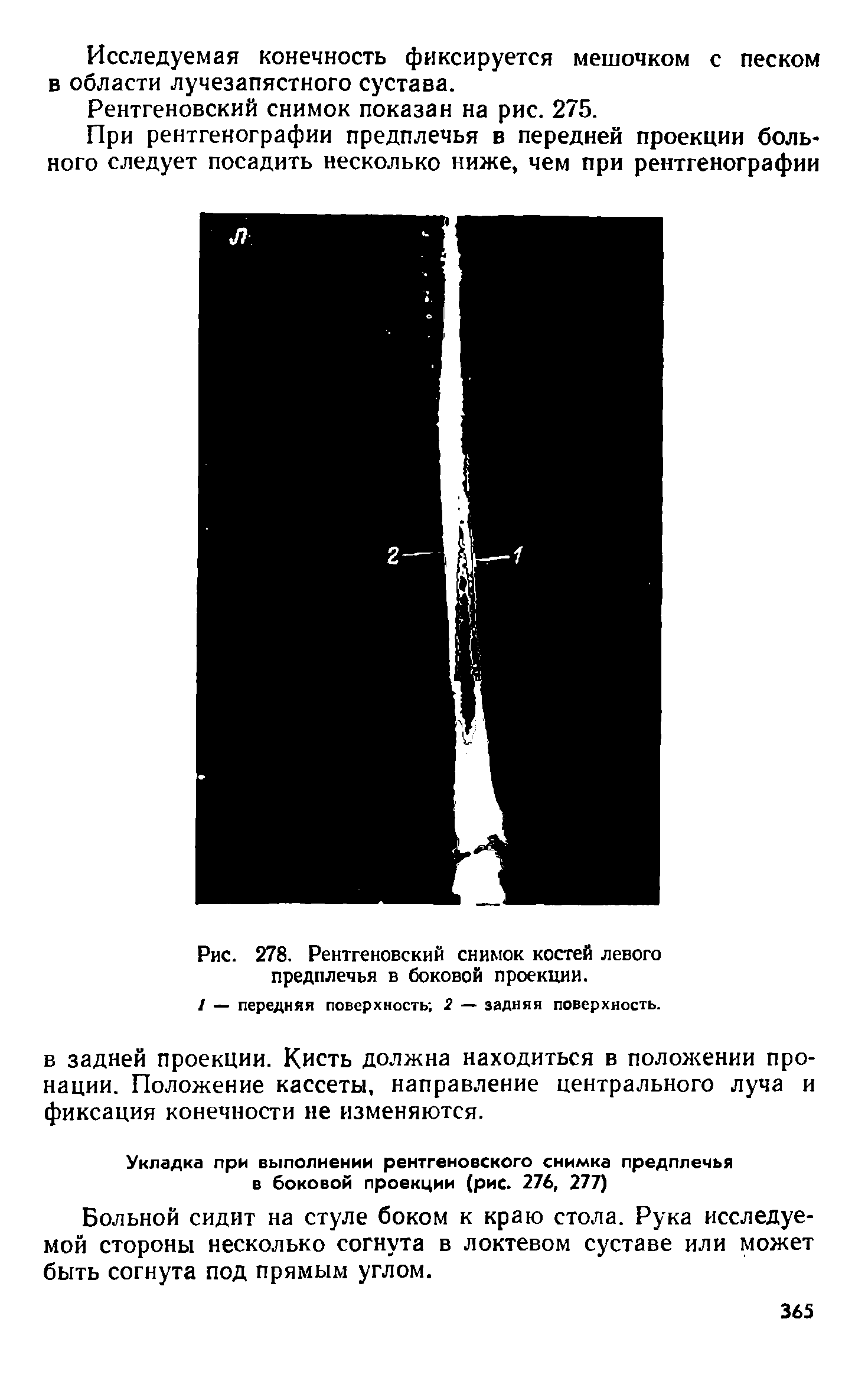 Рис. 278. Рентгеновский снимок костей левого предплечья в боковой проекции.