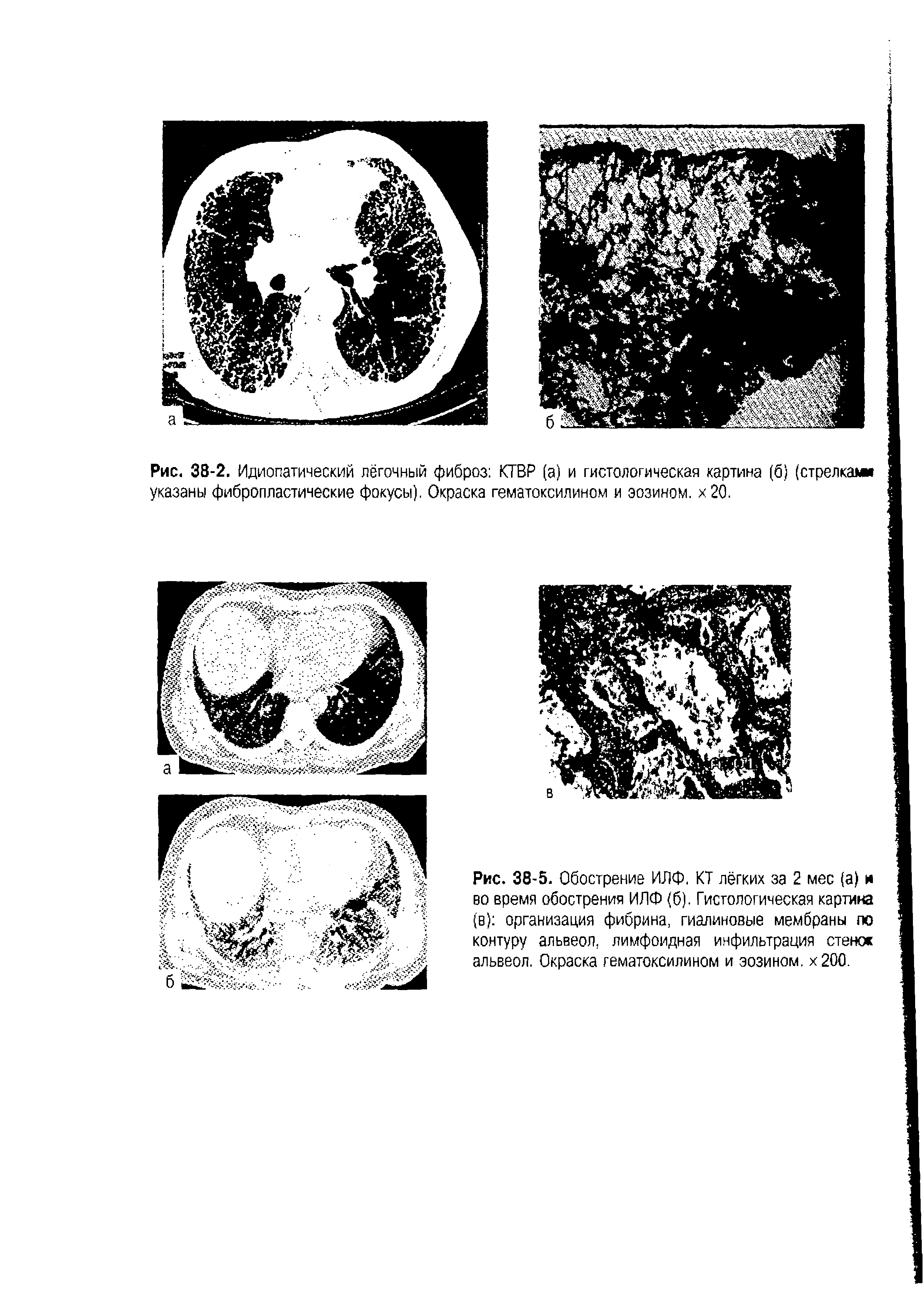 Рис. 38-5. Обострение ИЛФ. КТ лёгких за 2 мес (а) и во время обострения ИЛФ (б). Гистологическая картина (в) организация фибрина, гиалиновые мембраны по контуру альвеол, лимфоидная инфильтрация стенос альвеол. Окраска гематоксилином и эозином. х200.