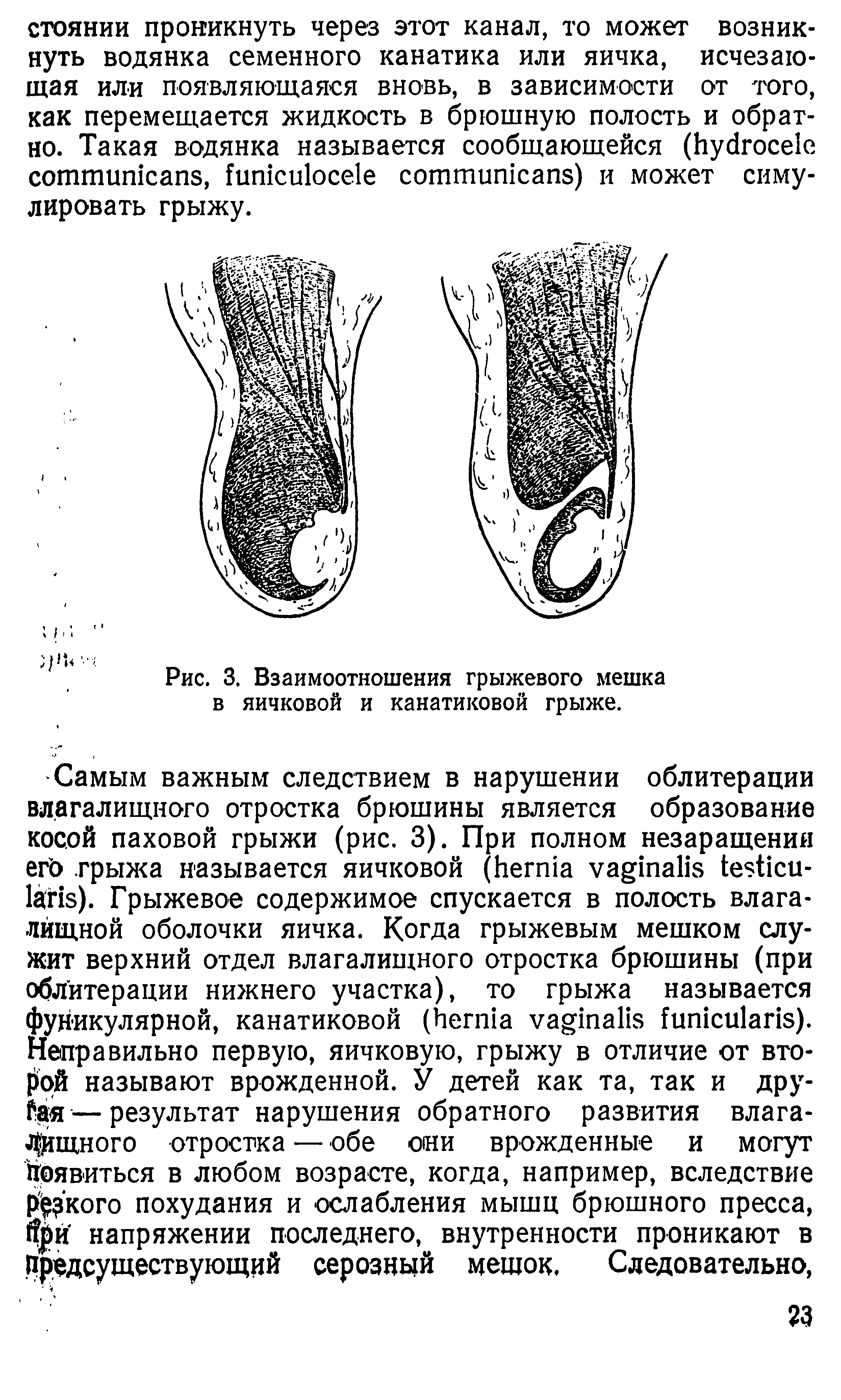 Рис. 3. Взаимоотношения грыжевого мешка в яичковой и канатиковой грыже.