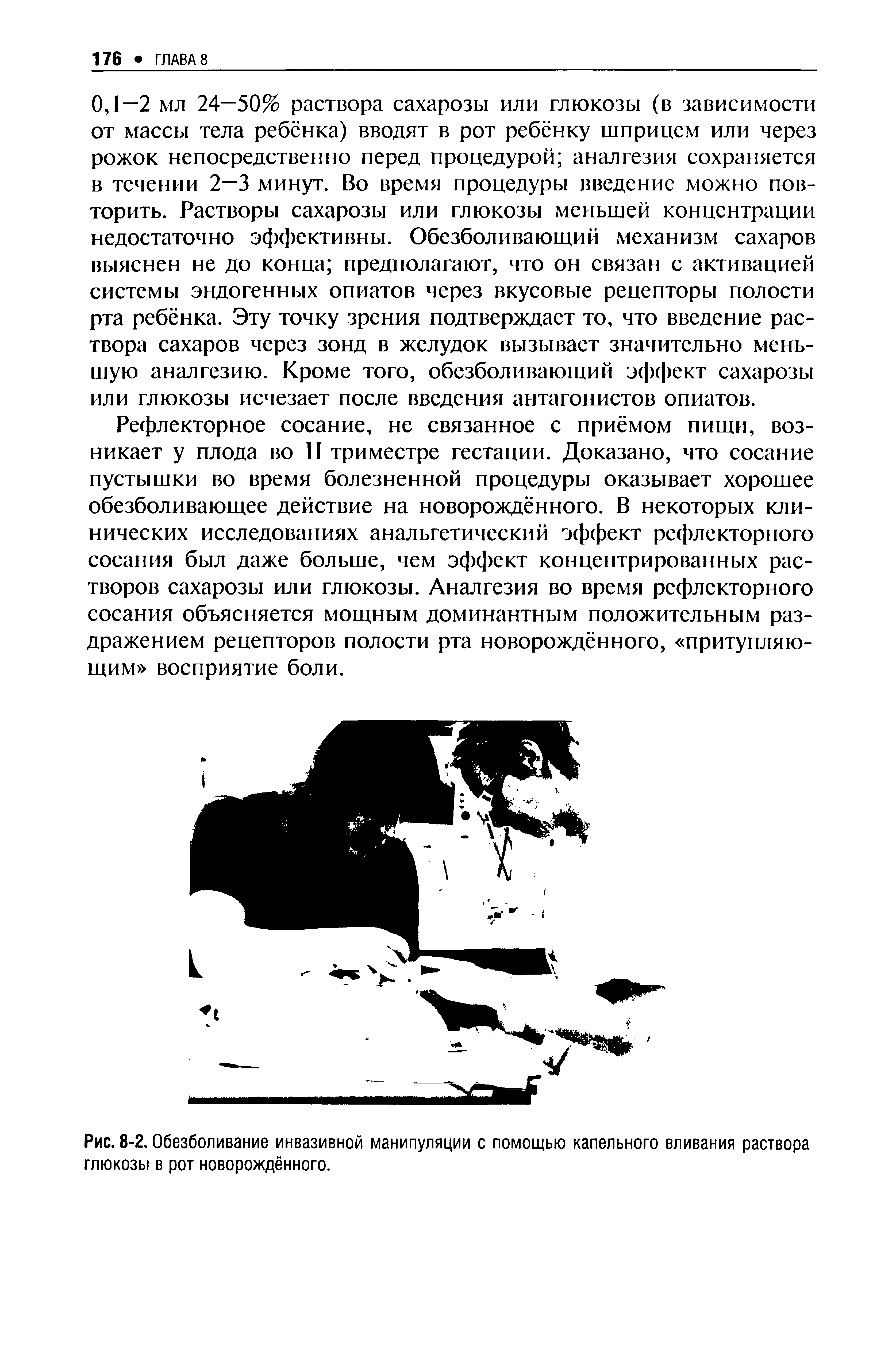 Рис. 8-2. Обезболивание инвазивной манипуляции с помощью капельного вливания раствора глюкозы в рот новорождённого.