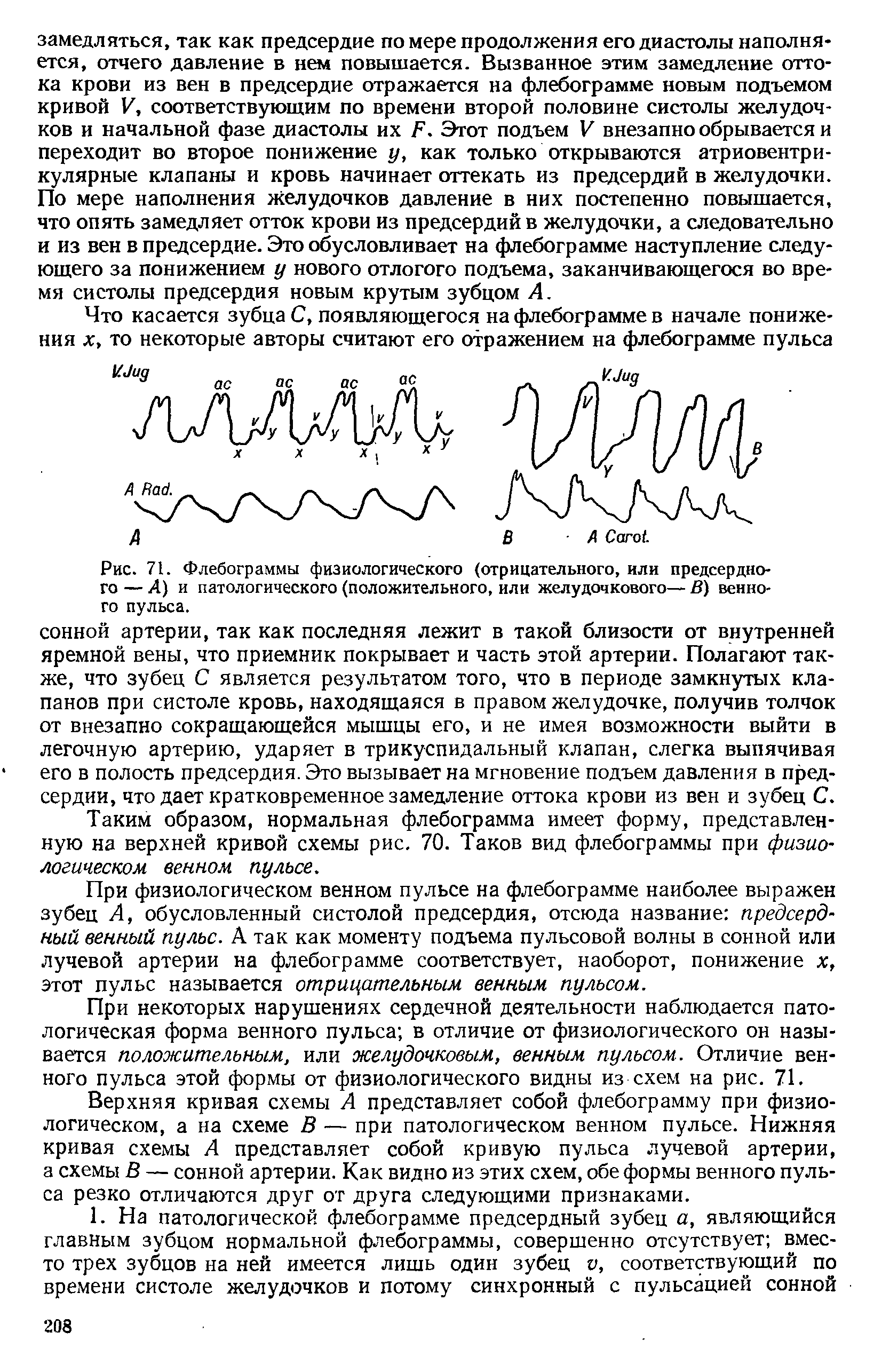 Рис. 71. Флебограммы физиологического (отрицательного, или предсердного — А) и патологического (положительного, или желудочкового— В) венного пульса.