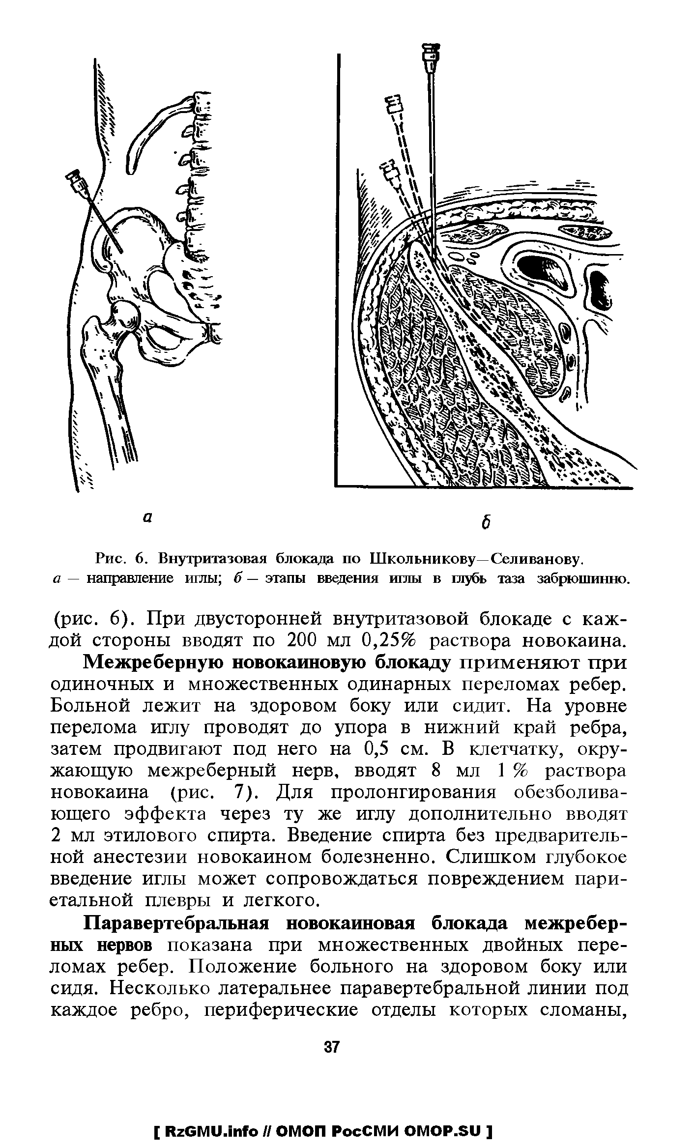 Рис. 6. Внутритазовая блокада по Школьникову—Селиванову. а — направление иглы б — этапы введения иглы в птубь таза забрюшинно.