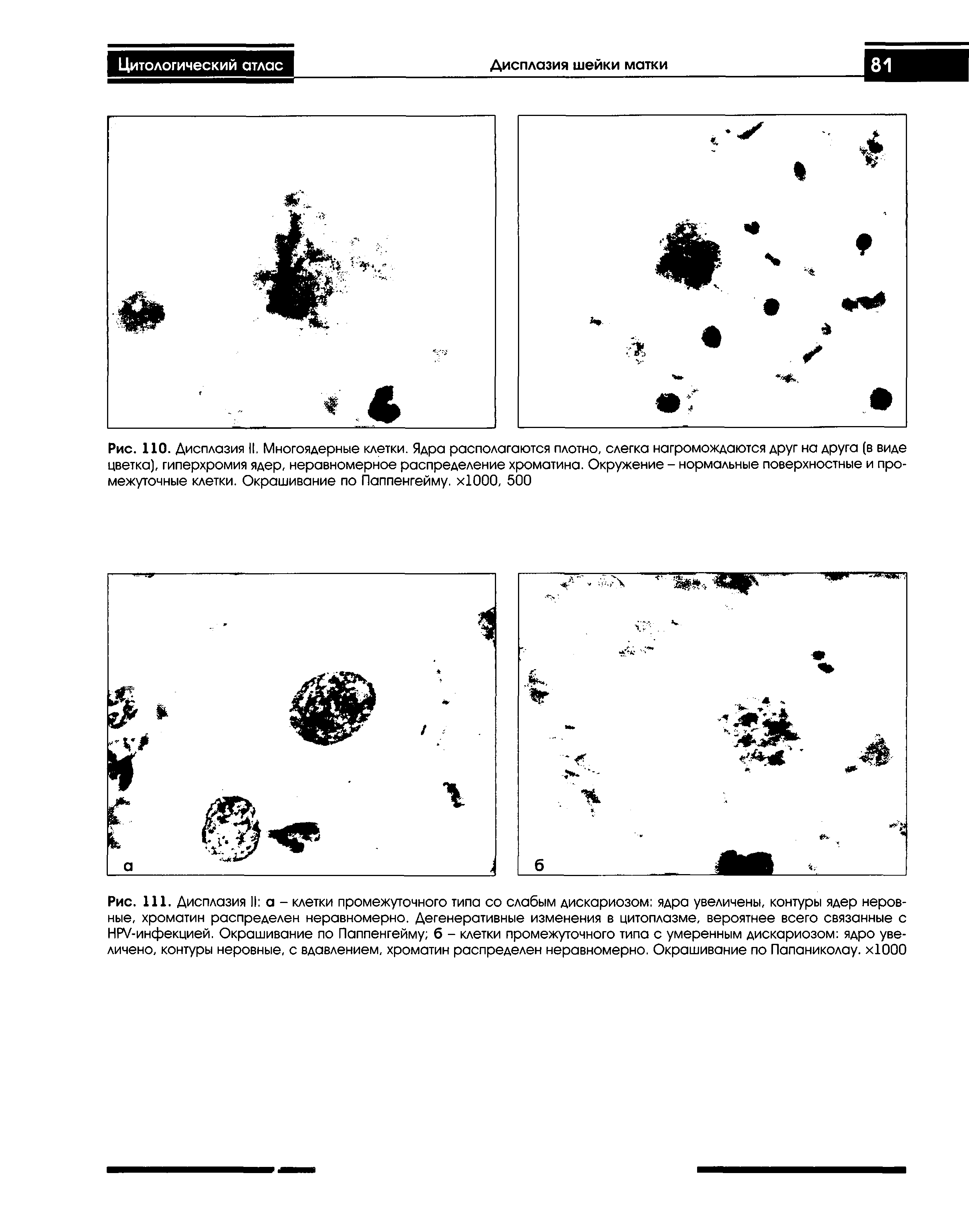 Рис. 110. Дисплазия II. Многоядерные клетки. Ядра располагаются плотно, слегка нагромождаются друг на друга (в виде цветка), гиперхромия ядер, неравномерное распределение хроматина. Окружение - нормальные поверхностные и промежуточные клетки. Окрашивание по Паппенгейму. хЮОО, 500...