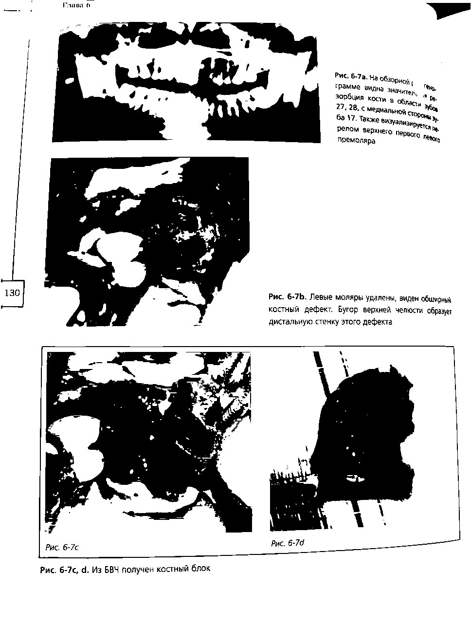 Рис. 6-7Ь. Левые моляры удалены, виден обширный костный дефект. Бугор верхней челюсти образует дистальную стенку этого дефекта...