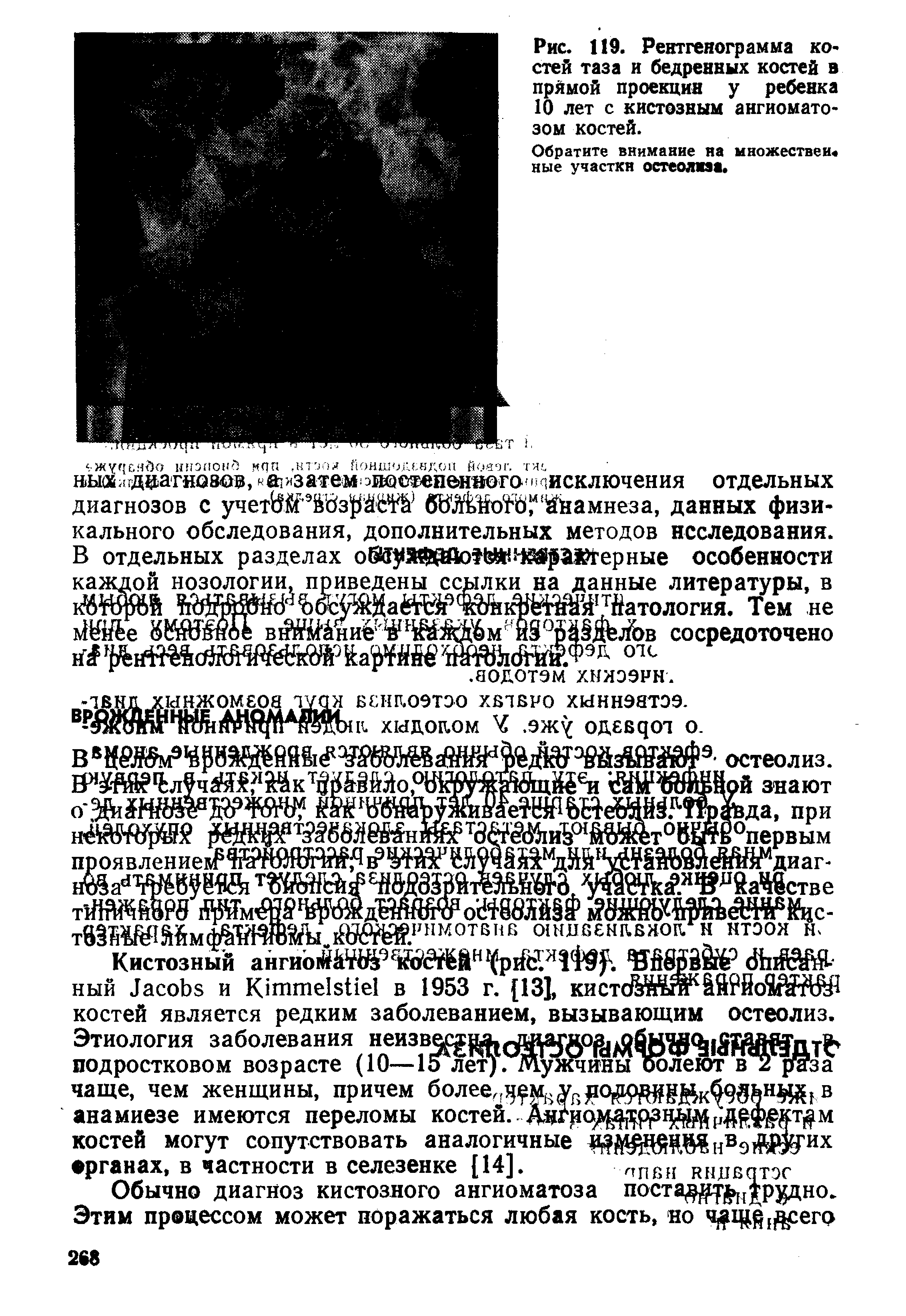 Рис. 119. Рентгенограмма костей таза и бедренных костей в прямой проекции у ребенка 10 лет с кистозным ангиоматозом костей.