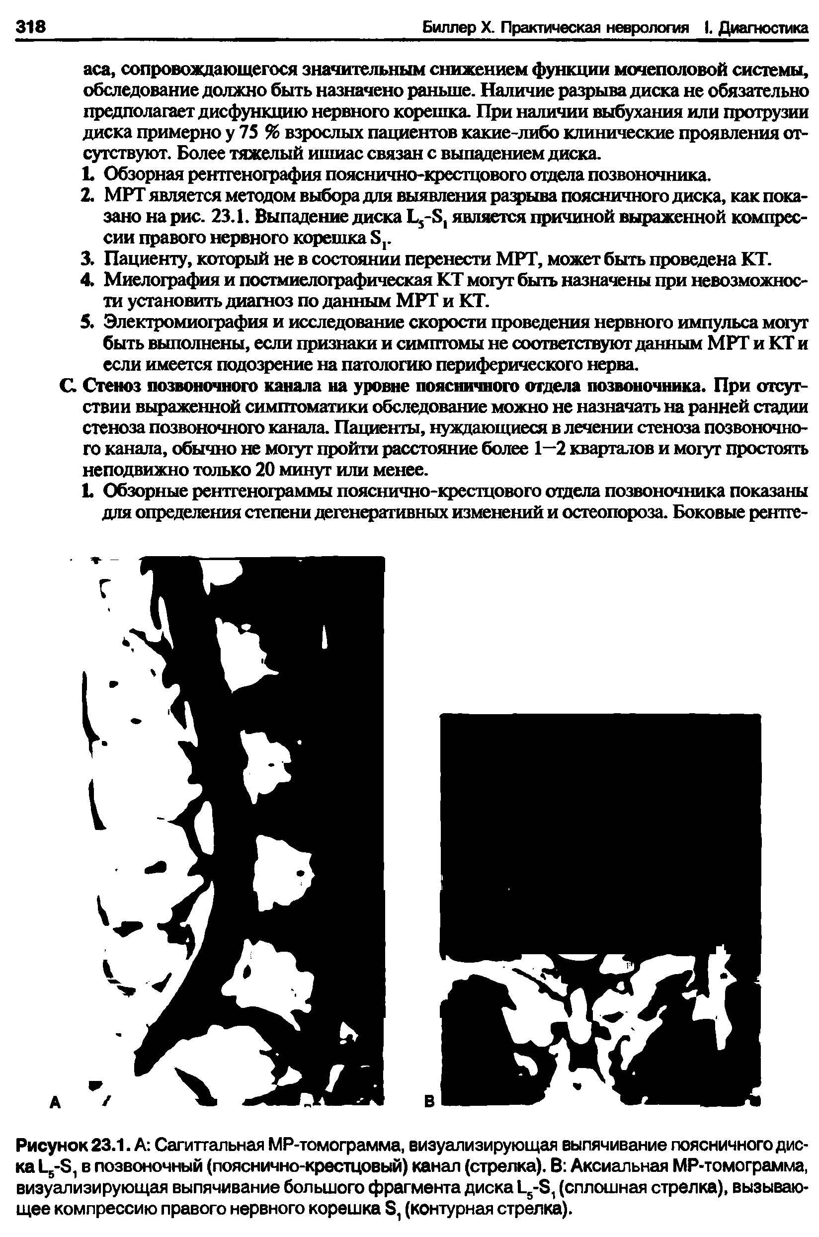 Рисунок 23.1. А Сагиттальная МР-томограмма, визуализирующая выпячивание поясничного диска 1 6-Б, в позвоночный (пояснично-крестцовый) канал (стрелка). В Аксиальная МР-томограмма, визуализирующая выпячивание большого фрагмента диска Ц-Б, (сплошная стрелка), вызывающее компрессию правого нервного корешка Б, (контурная стрелка).