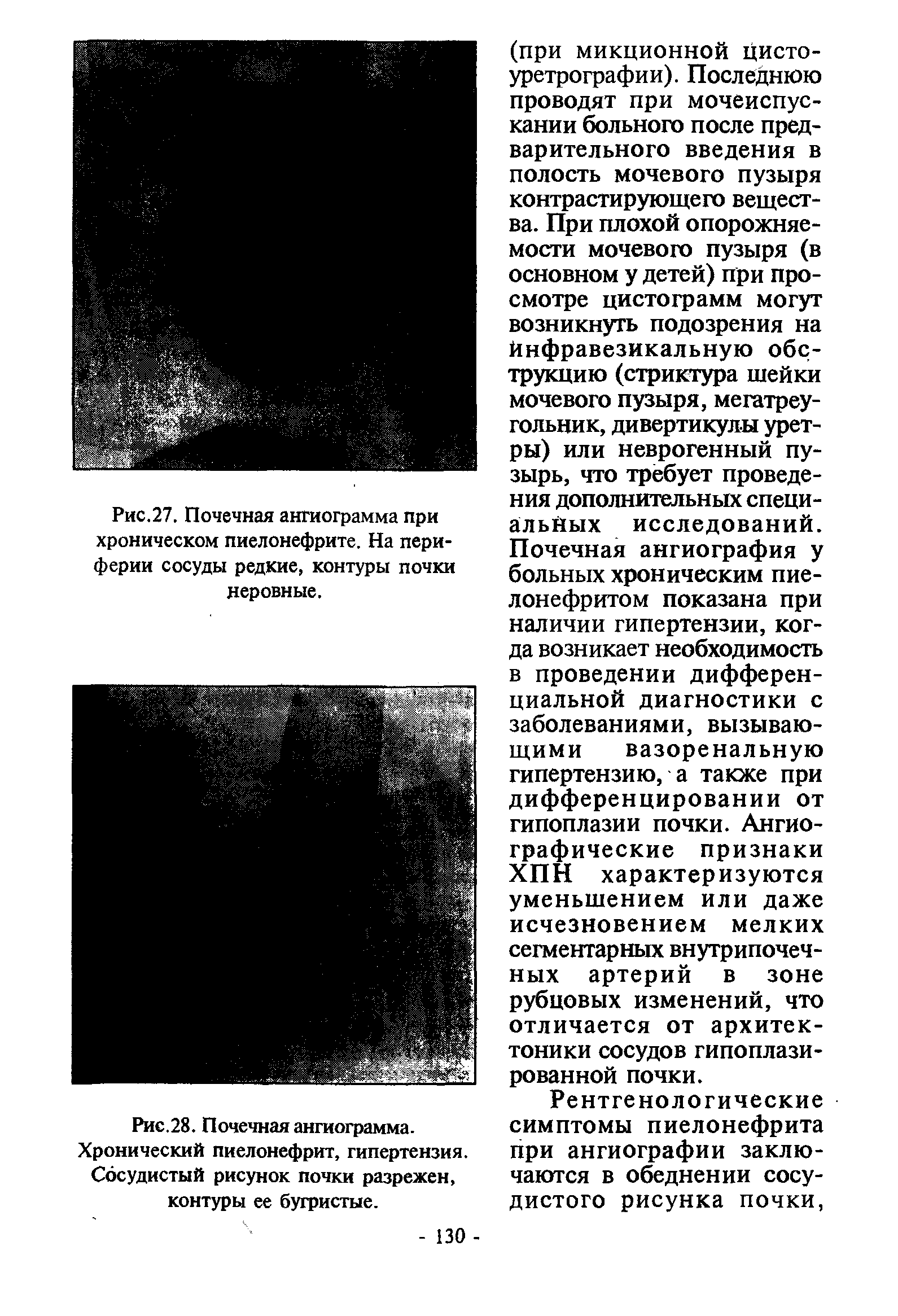 Рис.28. Почечная ангиограмма. Хронический пиелонефрит, гипертензия. Сосудистый рисунок почки разрежен, контуры ее бугристые.