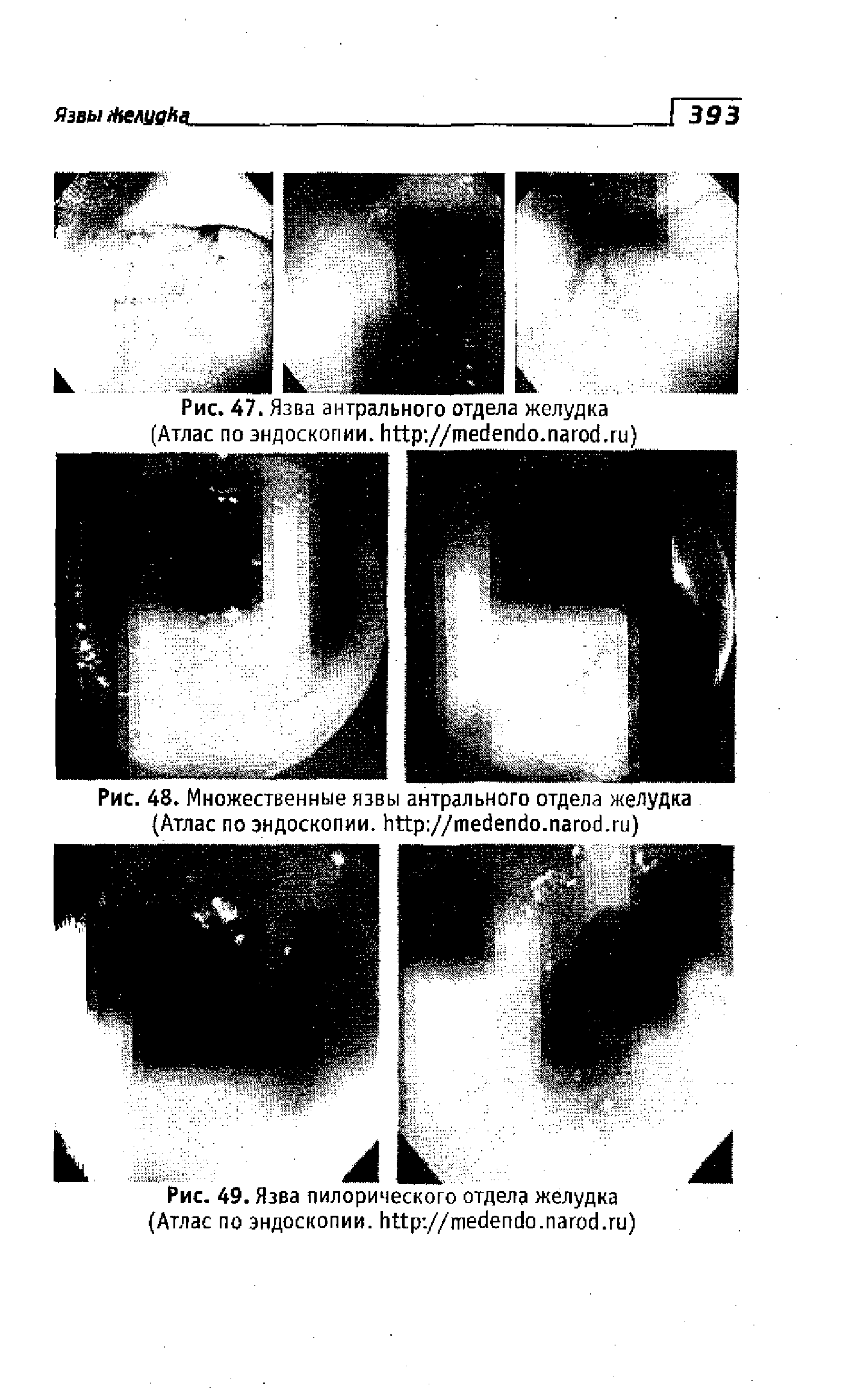 Рис. 47. Язва антрального отдела желудка (Атлас по эндоскопии, // . . )...