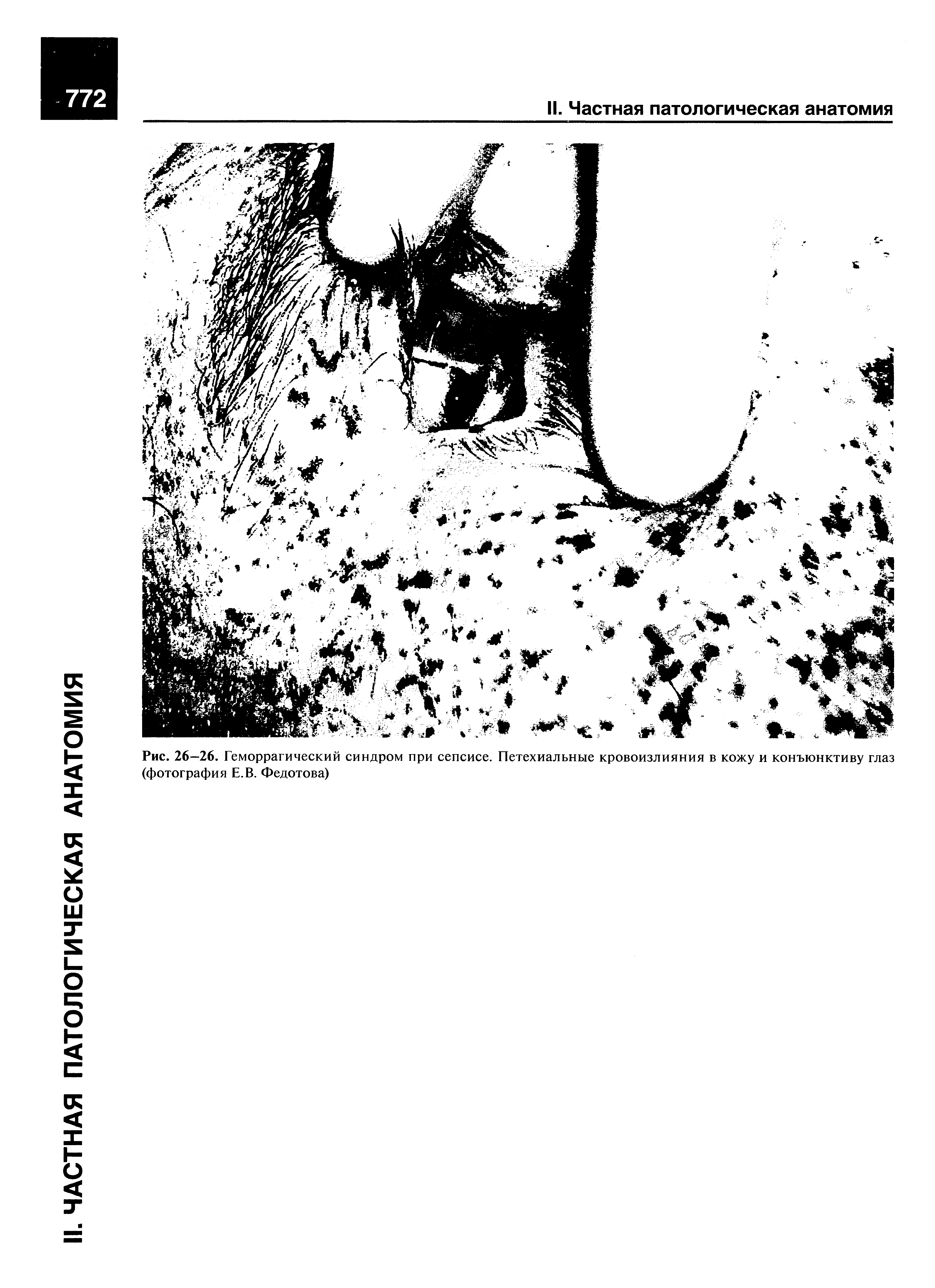 Рис. 26—26. Геморрагический синдром при сепсисе. Петехиальные кровоизлияния в кожу и конъюнктиву глаз (фотография Е.В. Федотова)...
