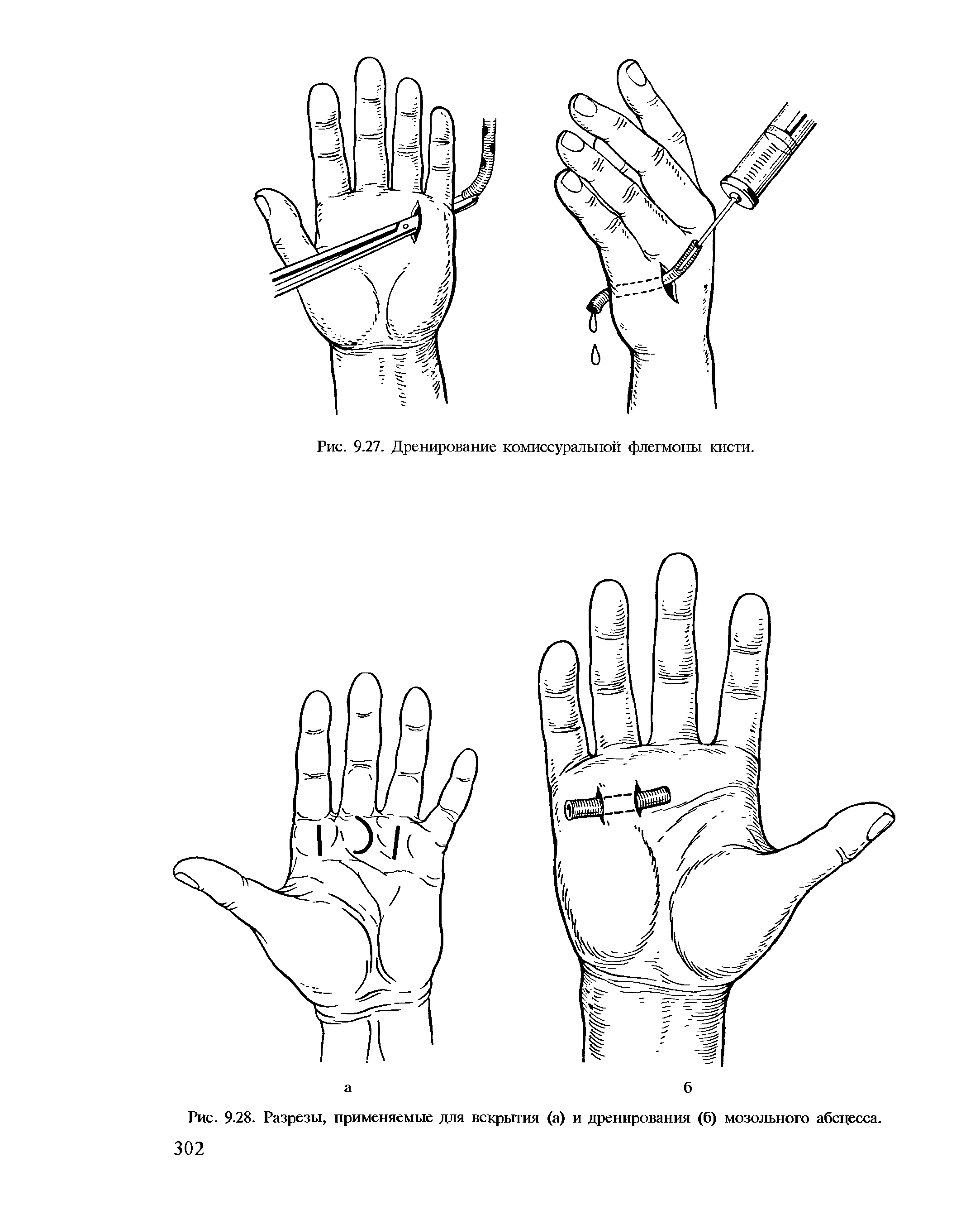 Рис. 9.28. Разрезы, применяемые для вскрытия (а) и дренирования (б) мозольного абсцесса.