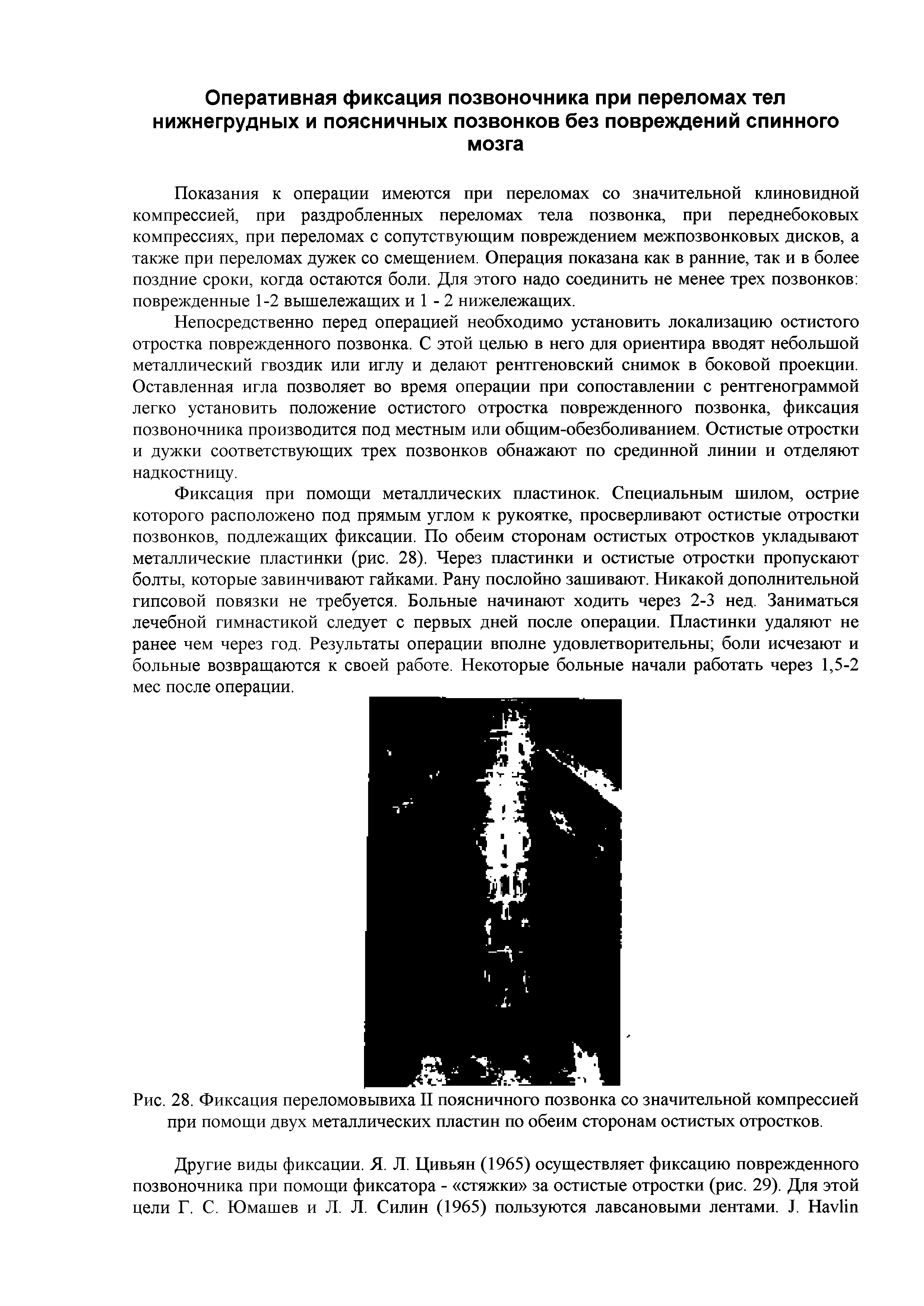 Рис. 28. Фиксация переломовывиха II поясничного позвонка со значительной компрессией при помощи двух металлических пластин по обеим сторонам остистых отростков.