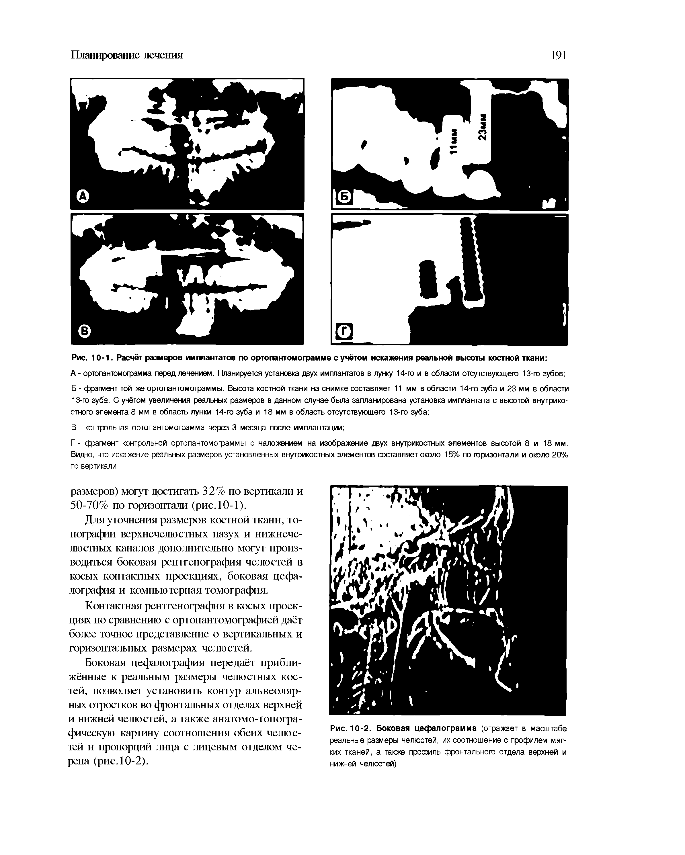 Рис. 10-1. Расчёт размеров имплантатов по ортопантомограмме с учётом искажения реальной высоты костной ткани ...