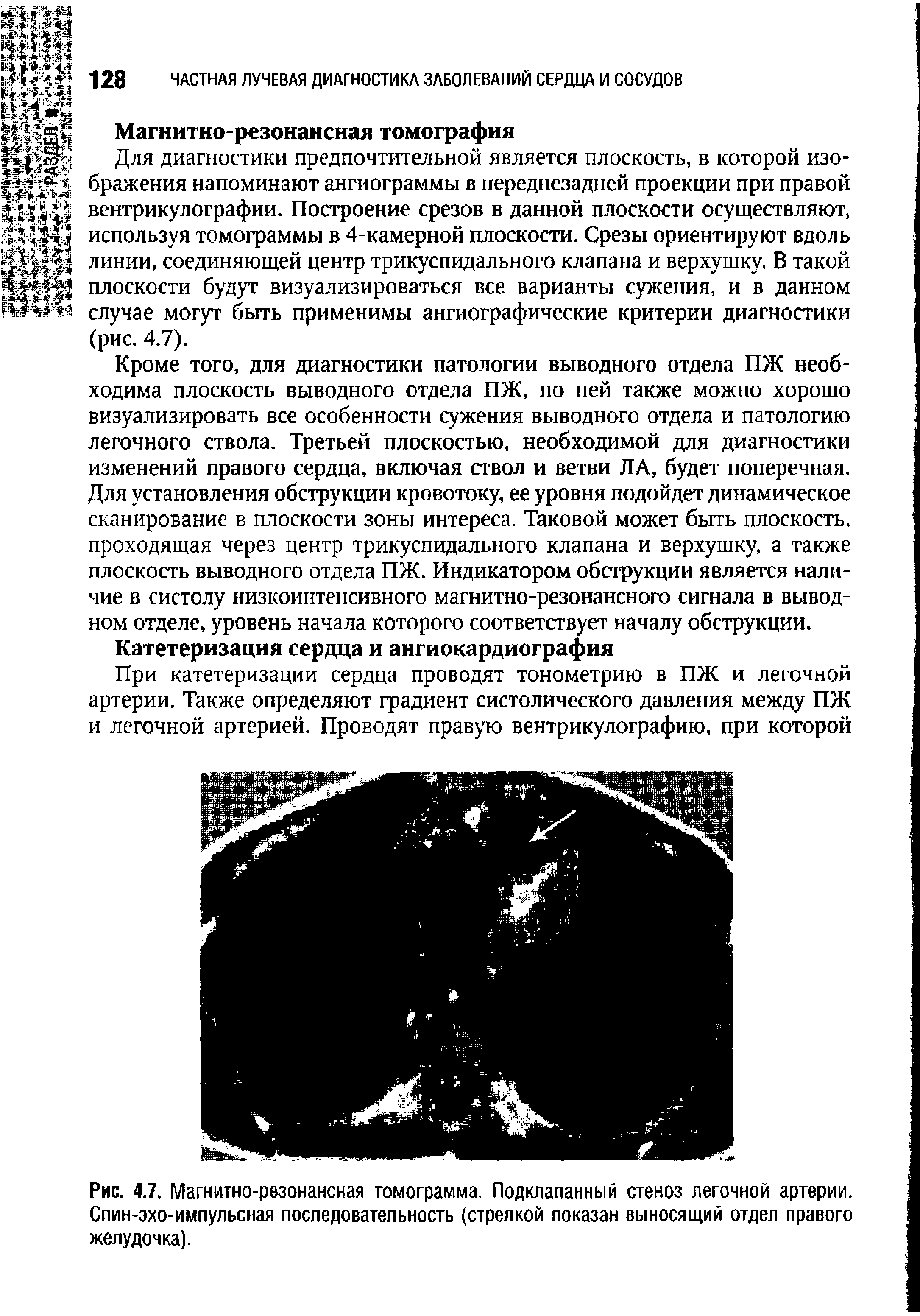 Рис. 4.7. Магнитно-резонансная томограмма. Подклапанный стеноз легочной артерии. Спин-эхо-импульсная последовательность (стрелкой показан выносящий отдел правого желудочка).