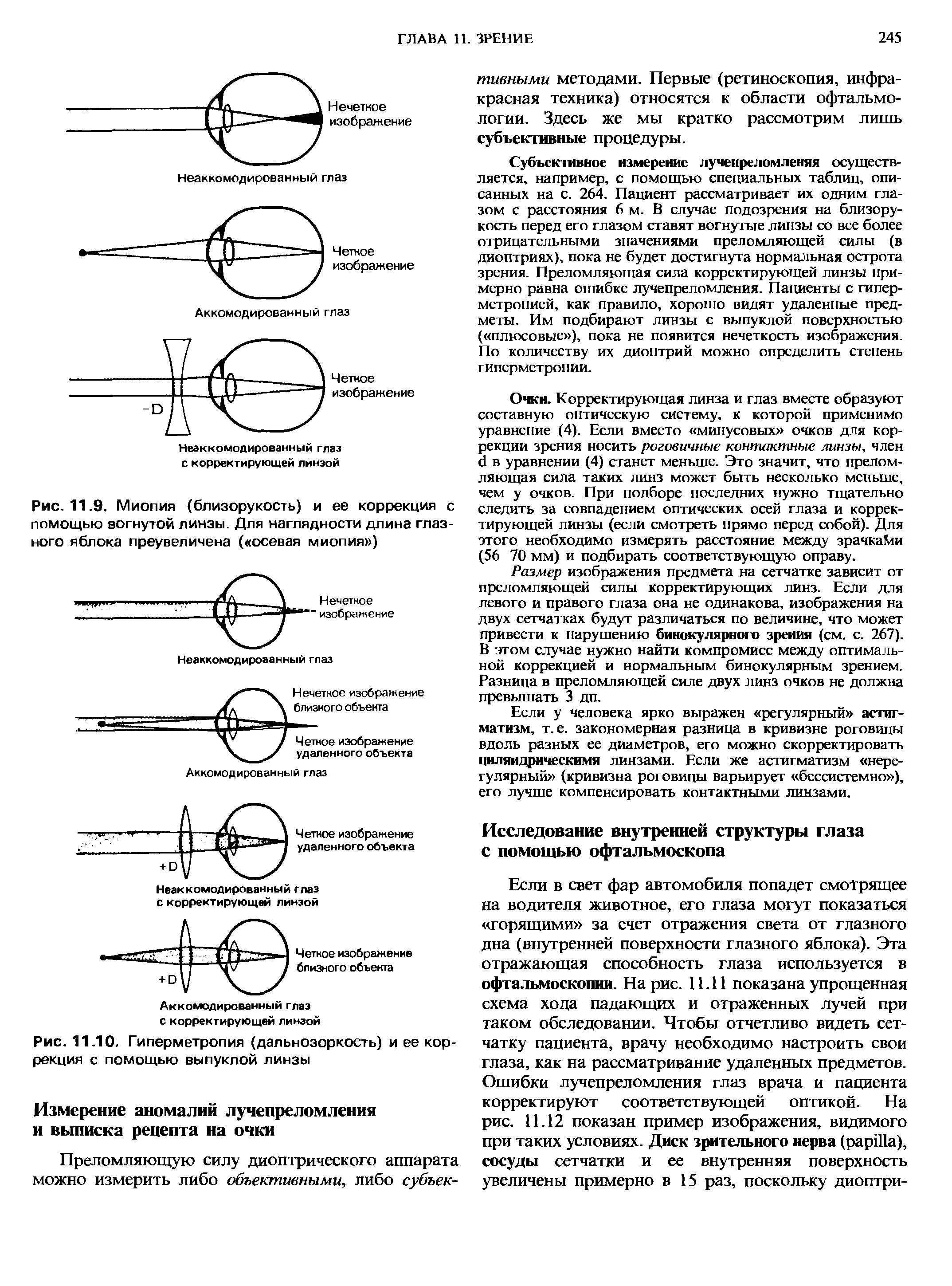 Рис. 11.9. Миопия (близорукость) и ее коррекция с помощью вогнутой линзы. Для наглядности длина глазного яблока преувеличена ( осевая миопия )...