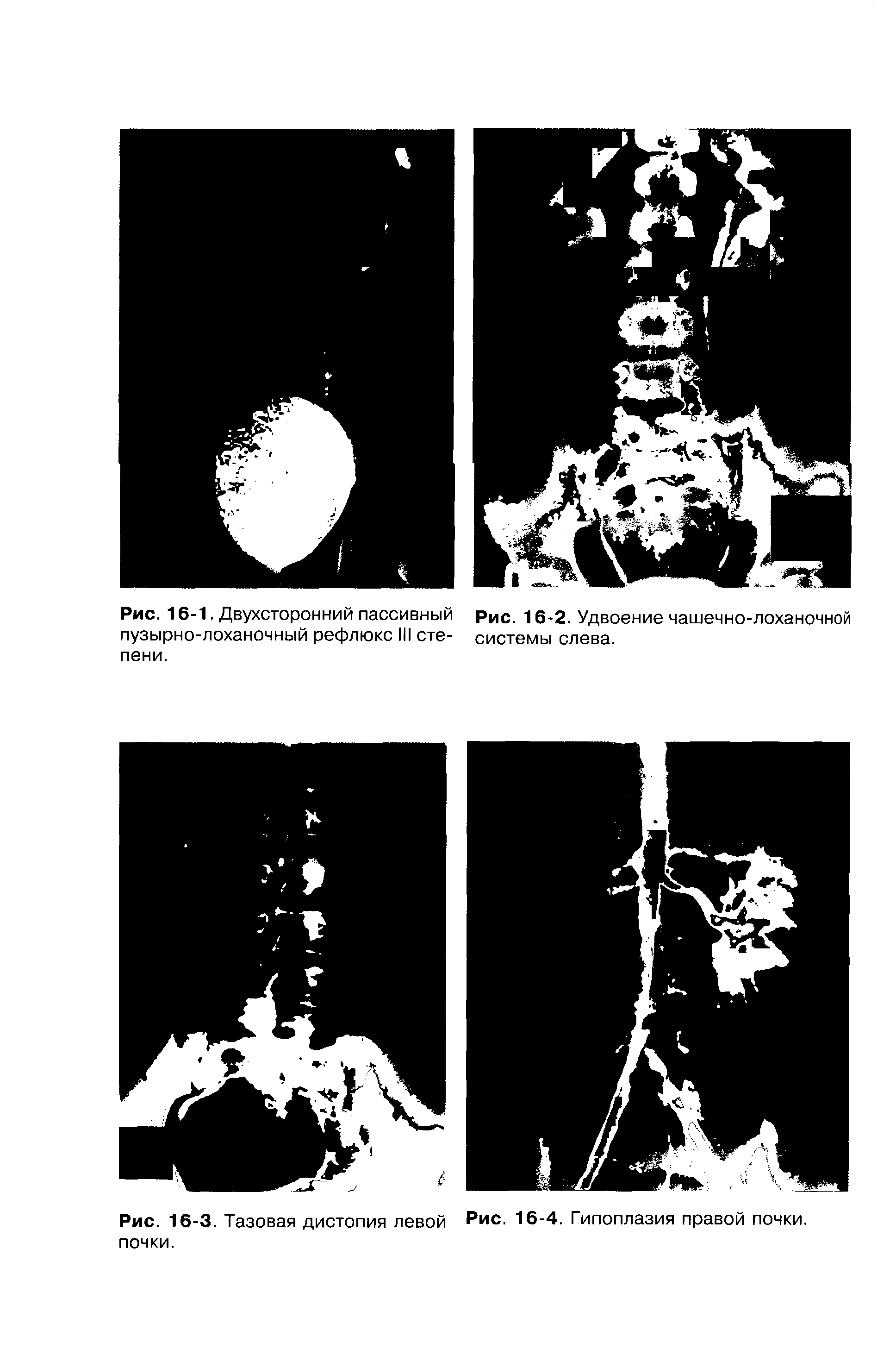 Рис. 16-3. Тазовая дистопия левой Рис. 16-4. Гипоплазия правой почки, почки.