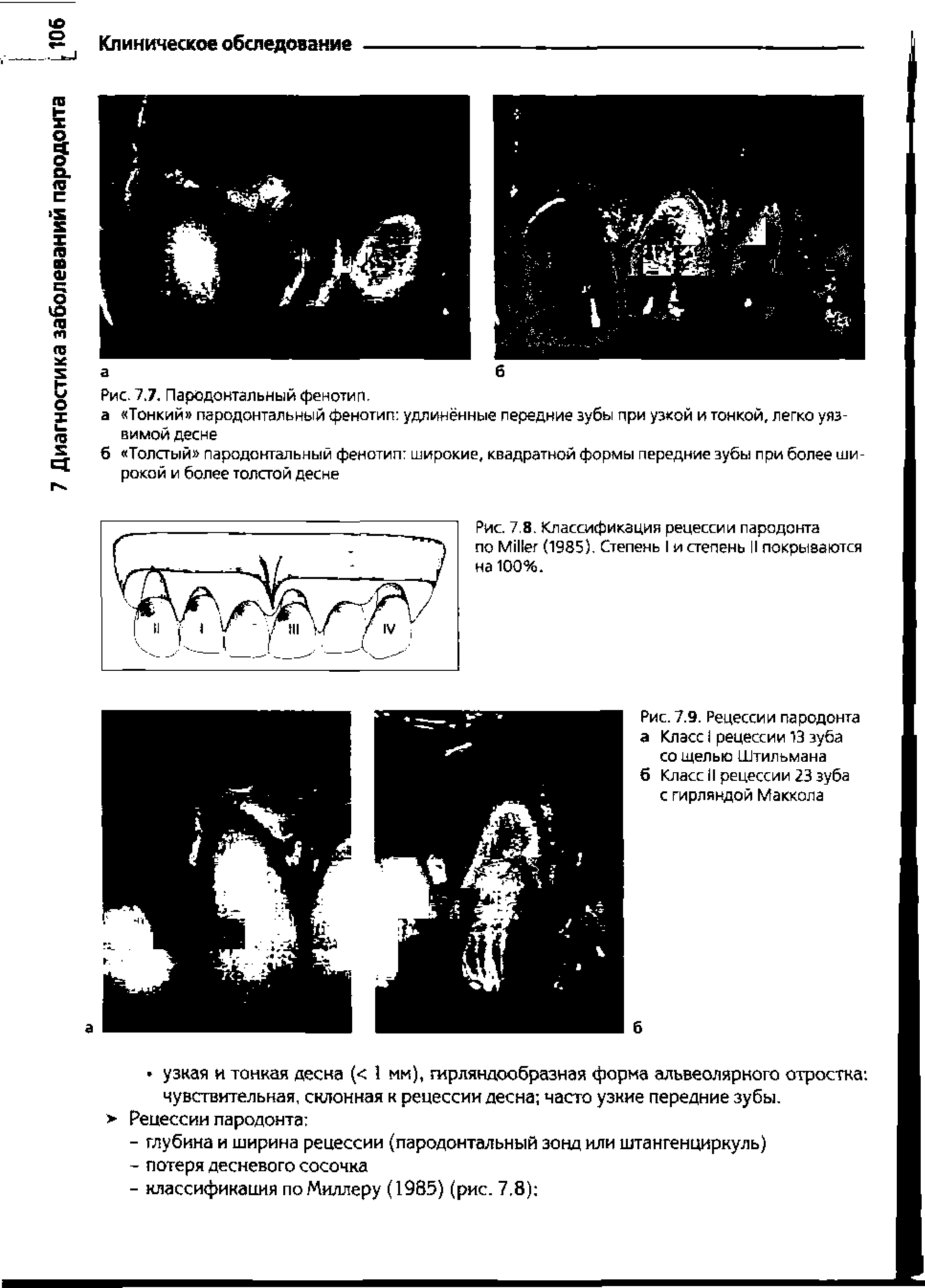 Рис. 7.8. Классификация рецессии пародонта по M (1985). Степень I и степень II покрываются на 100%.