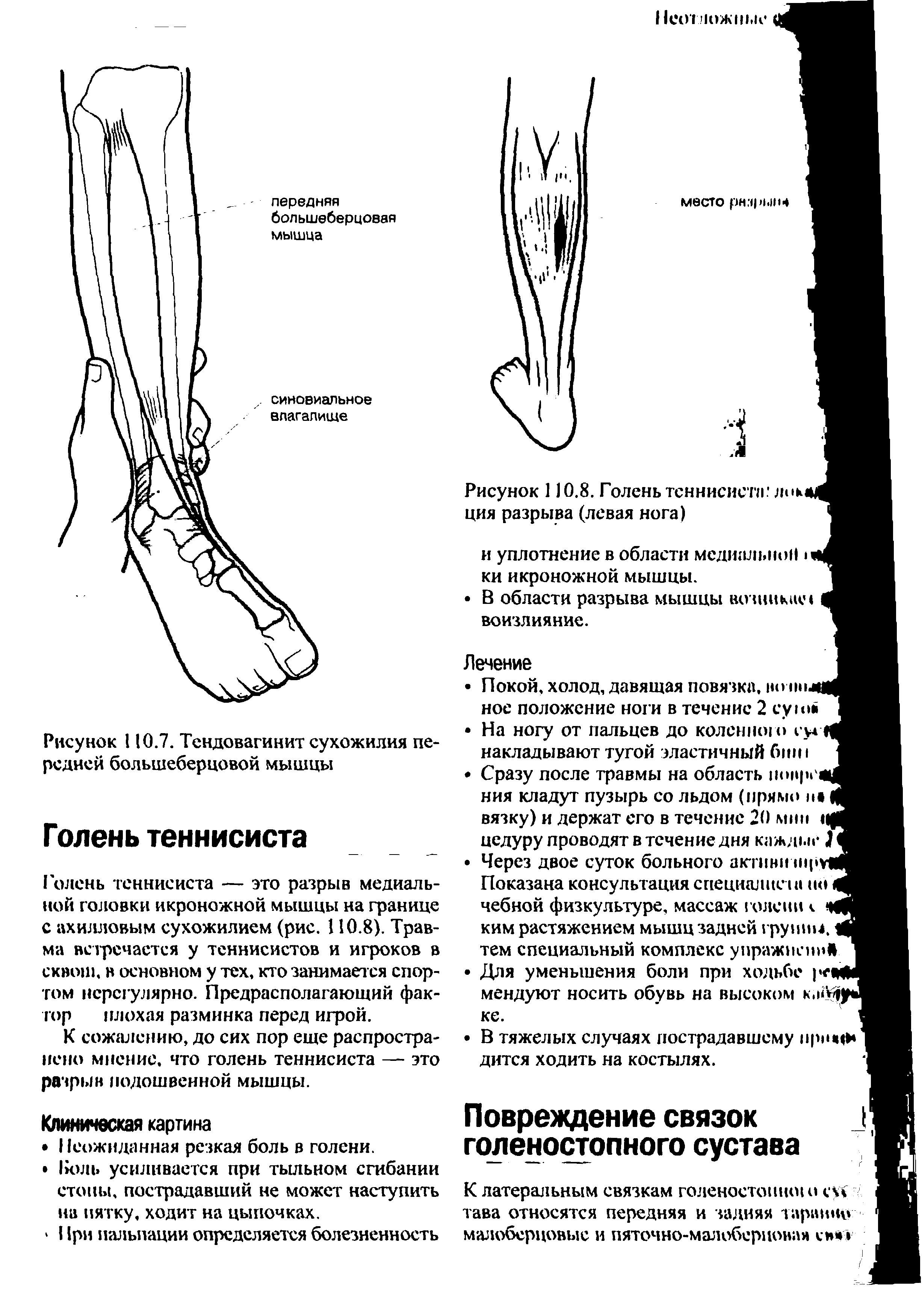 Рисунок 110.8. Голень теннисист. лик ция разрыва (левая нога)...