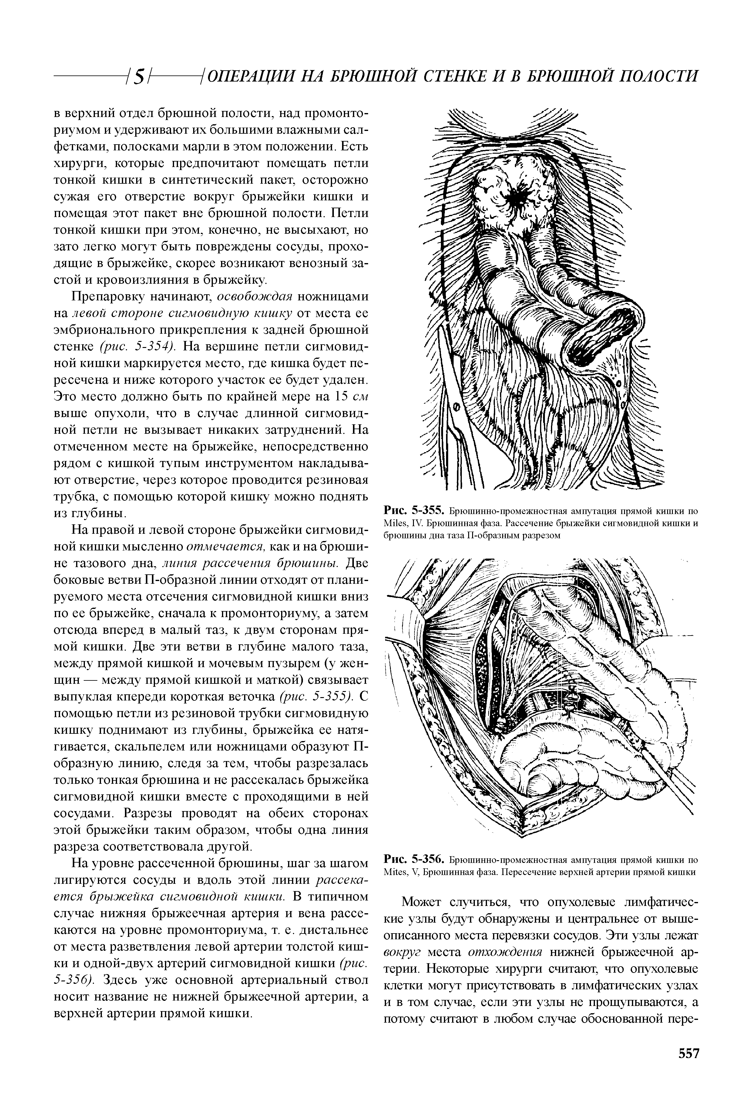 Рис. 5-356. Брюшинно-промежностная ампутация прямой кишки по M , V, Брюшинная фаза. Пересечение верхней артерии прямой кишки...