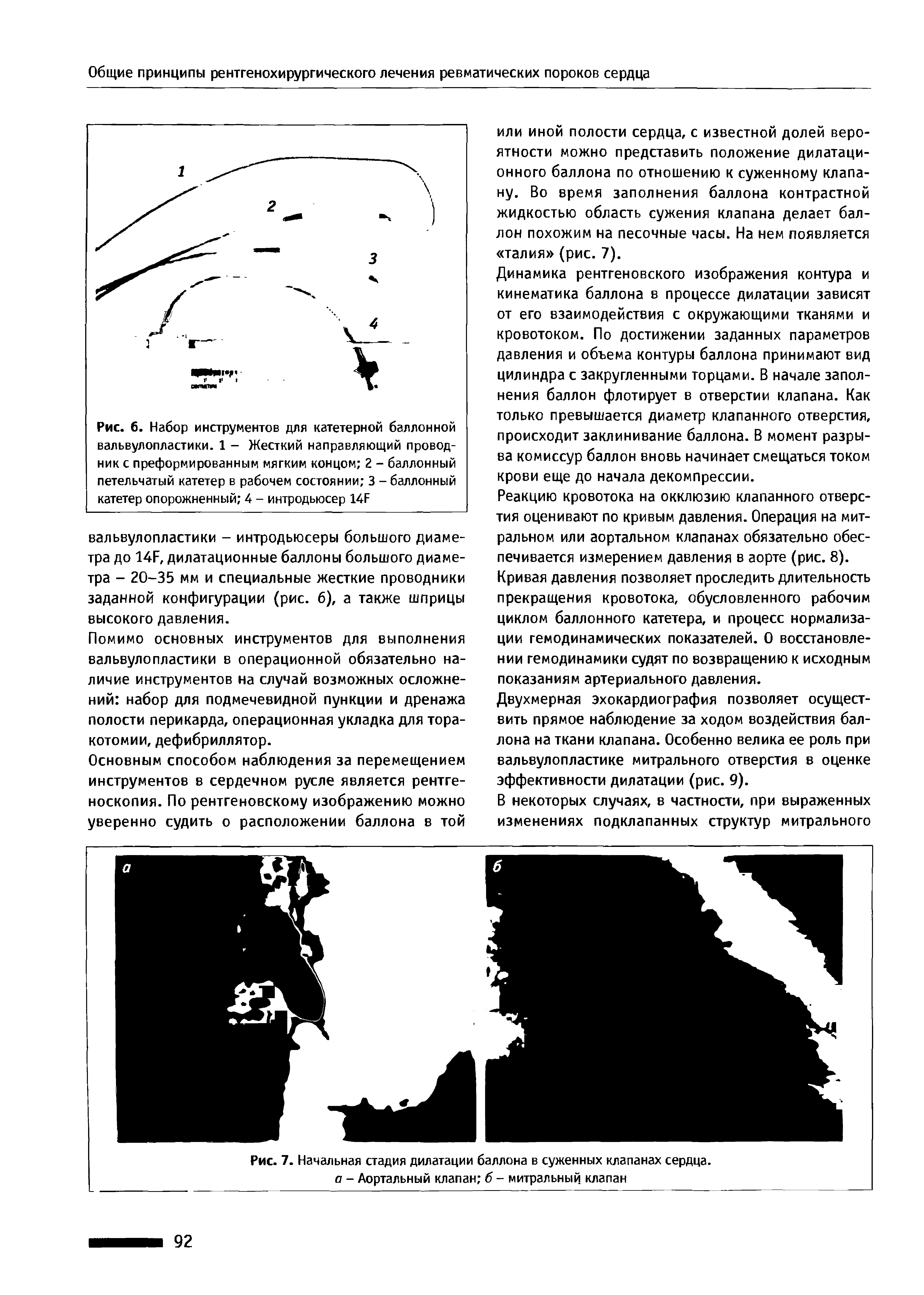 Рис. 7. Начальная стадия дилатации баллона в суженных клапанах сердца. а - Аортальный клапан б - митральный клапан...