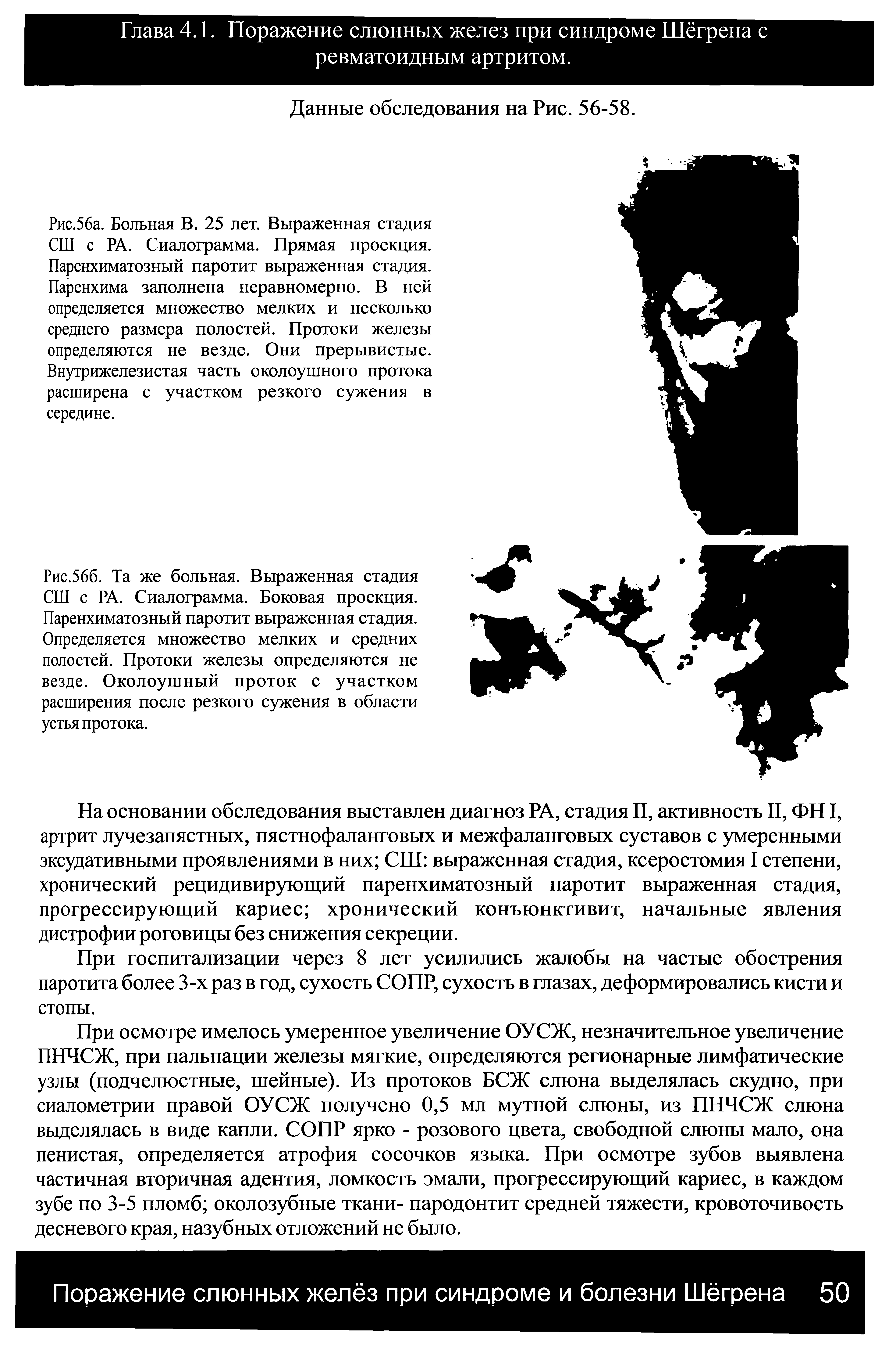 Рис.56б. Та же больная. Выраженная стадия СШ с РА. Сиалограмма. Боковая проекция. Паренхиматозный паротит выраженная стадия. Определяется множество мелких и средних полостей. Протоки железы определяются не везде. Околоушный проток с участком расширения после резкого сужения в области устья протока.