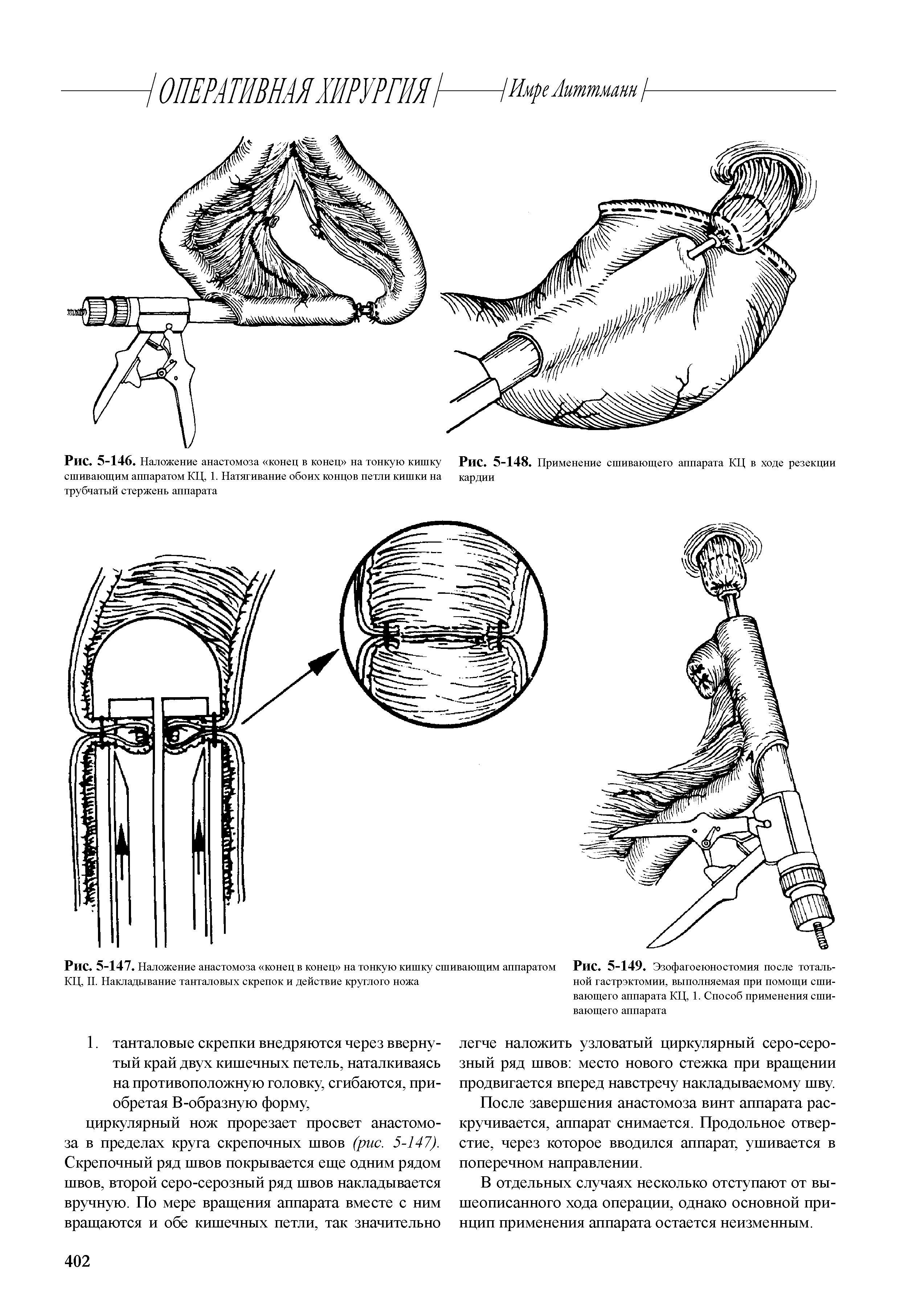 Рис. 5-146. Наложение анастомоза конец в конец на тонкую кишку Рис. 5-148. Применение сшивающего аппарата КЦ в ходе резекции сшивающим аппаратом КЦ, 1. Натягивание обоих концов петли кишки на кардии трубчатый стержень аппарата...