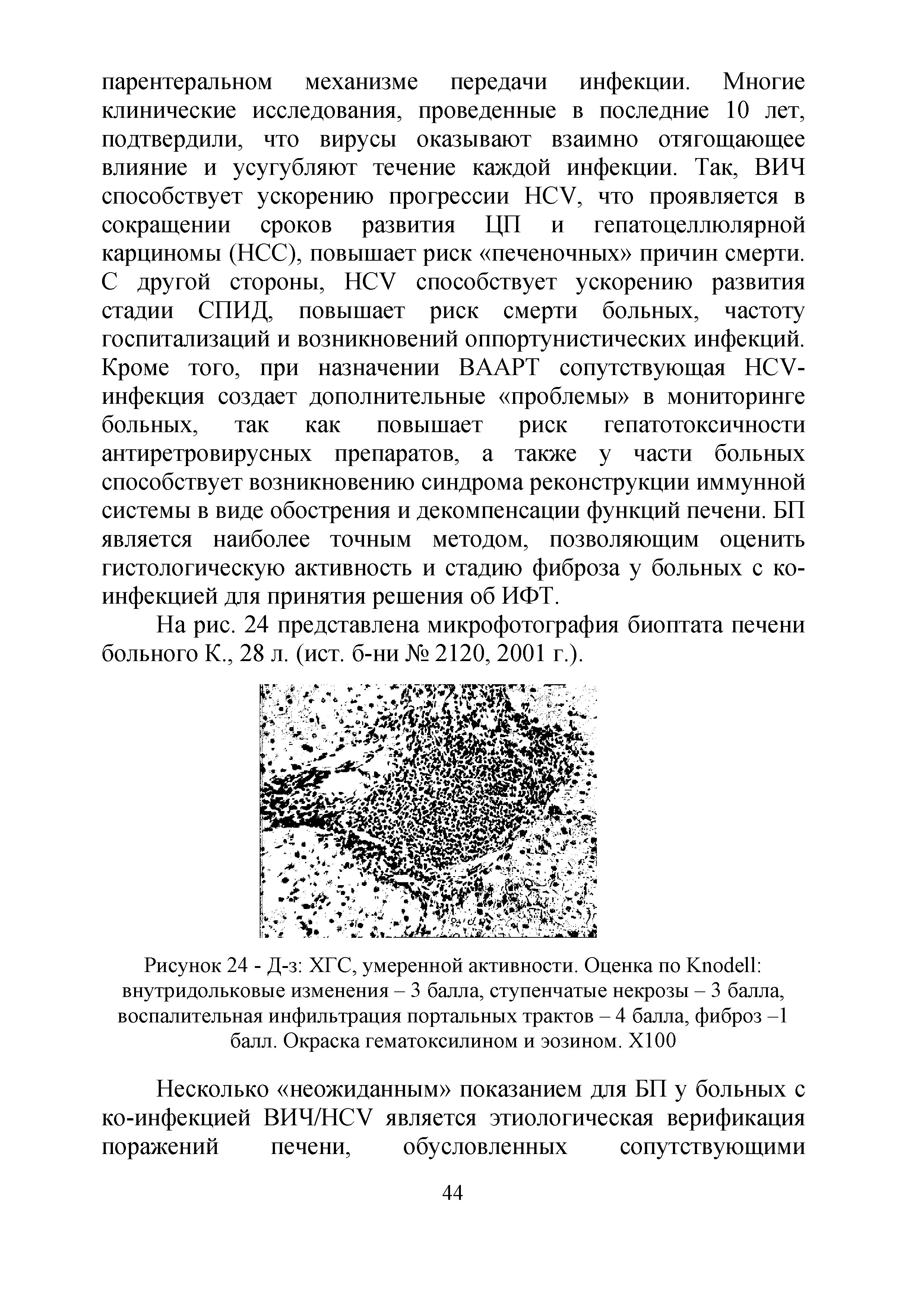 Рисунок 24 - Д-з ХГС, умеренной активности. Оценка по КпобеП внутридольковые изменения - 3 балла, ступенчатые некрозы - 3 балла, воспалительная инфильтрация портальных трактов - 4 балла, фиброз -1 балл. Окраска гематоксилином и эозином. XI00...