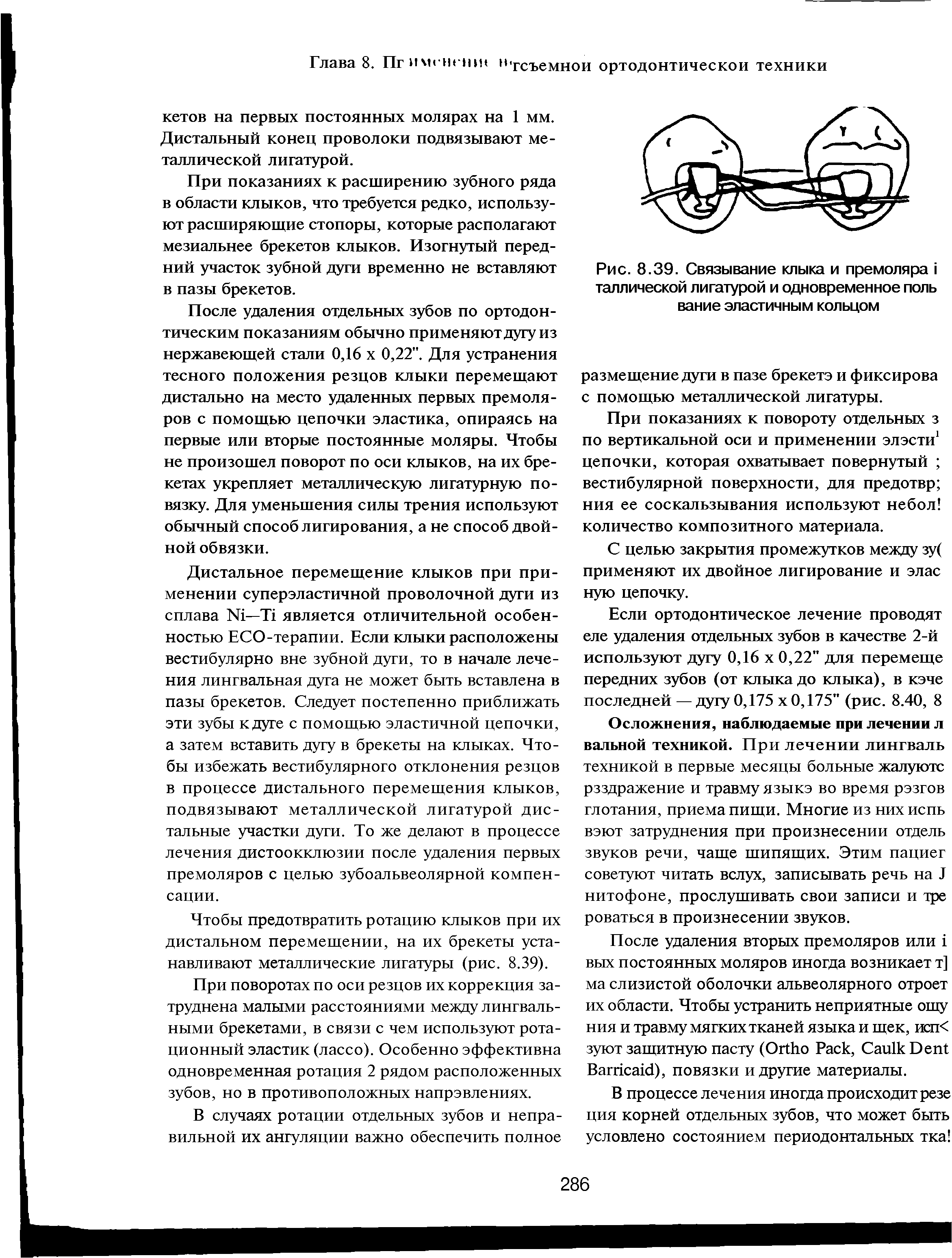 Рис. 8.39. Связывание клыка и премоляра I таллической лигатурой и одновременное поль вание эластичным кольцом...