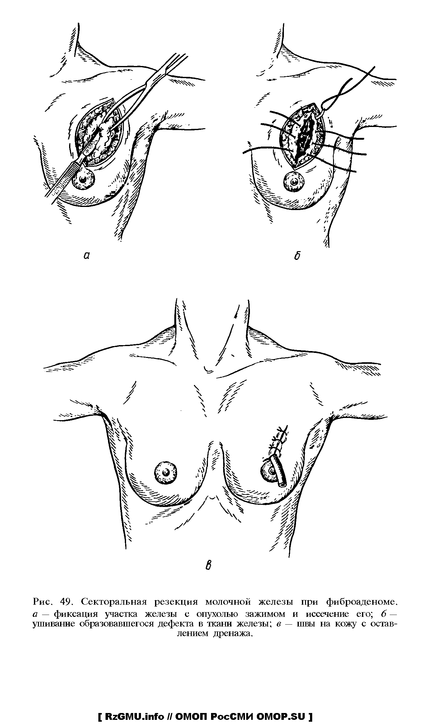 Рис. 49. Секторальная резекция молочной железы при фиброаденоме. а — фиксация участка железы с опухолью зажимом и иссечение его 6 — ушивание образовавшегося дефекта в ткани железы в — швы на кожу с оставлением дренажа.
