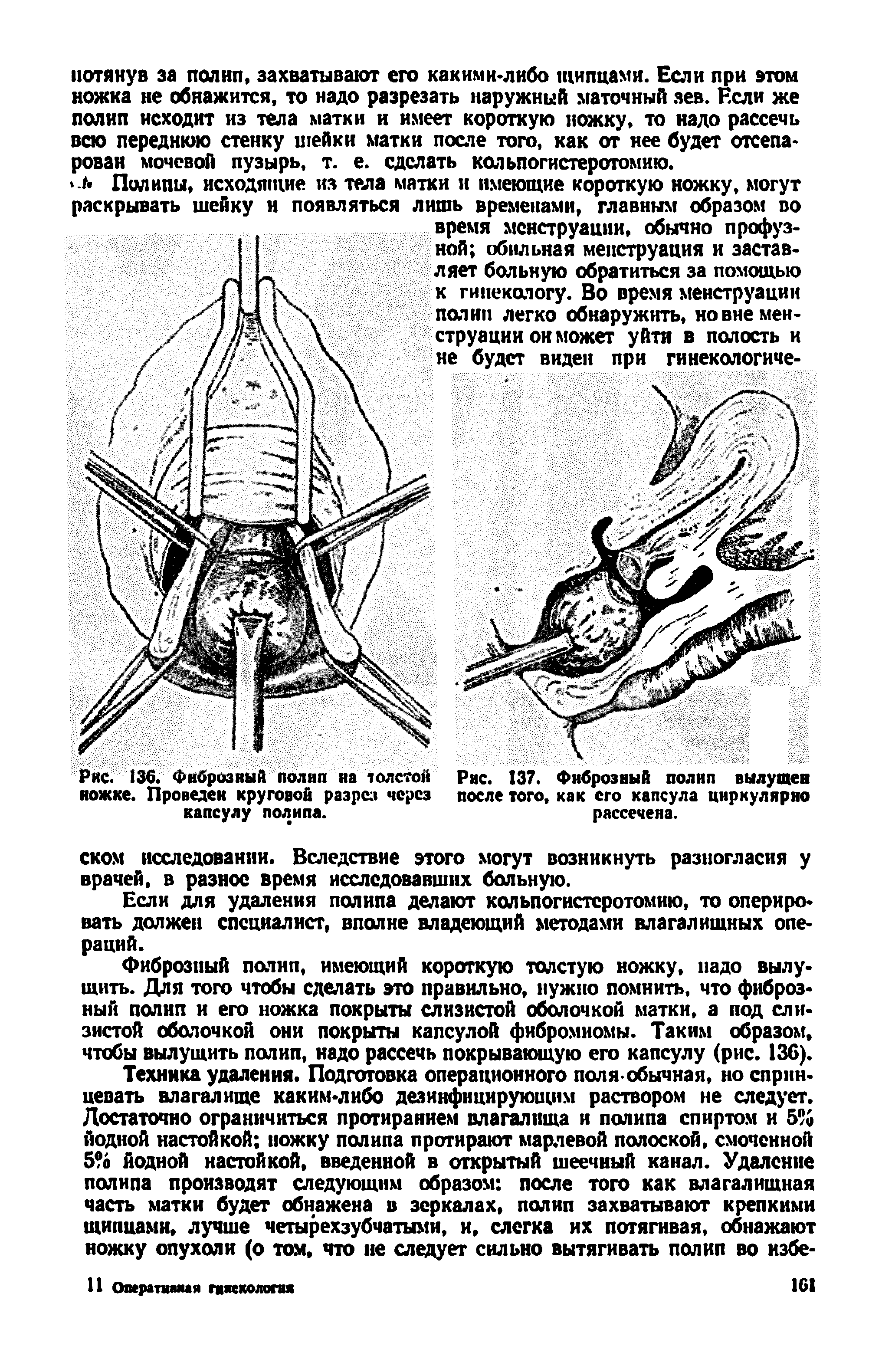 Рис. 136. Фиброзный полип на толсто Рис. 137. Фиброзный полип вылущен ножке. Проведен круговой разрез через после того, как его капсула циркулярно капсулу полипа. рассечена.