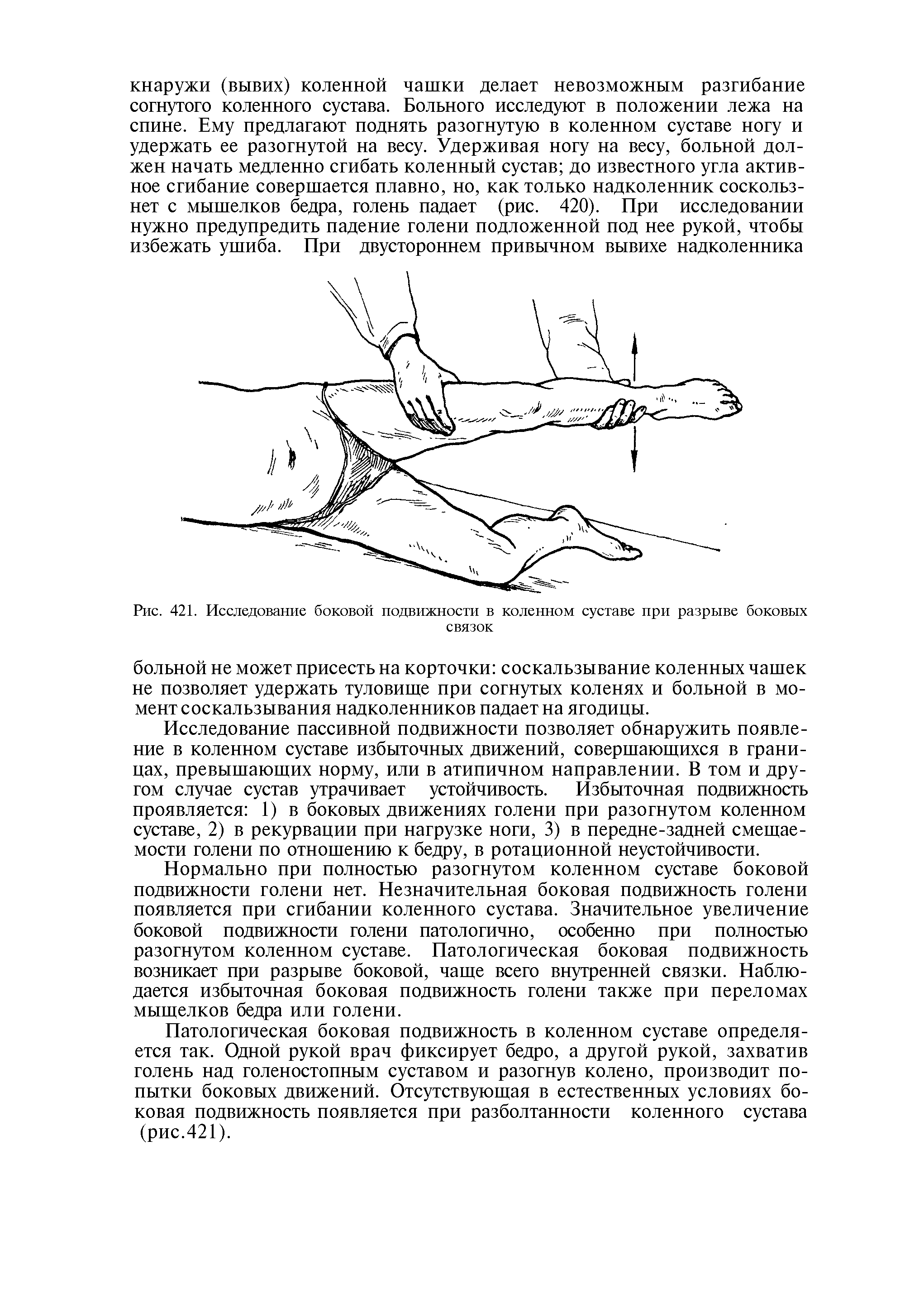 Рис. 421. Исследование боковой подвижности в коленном суставе при разрыве боковых связок...