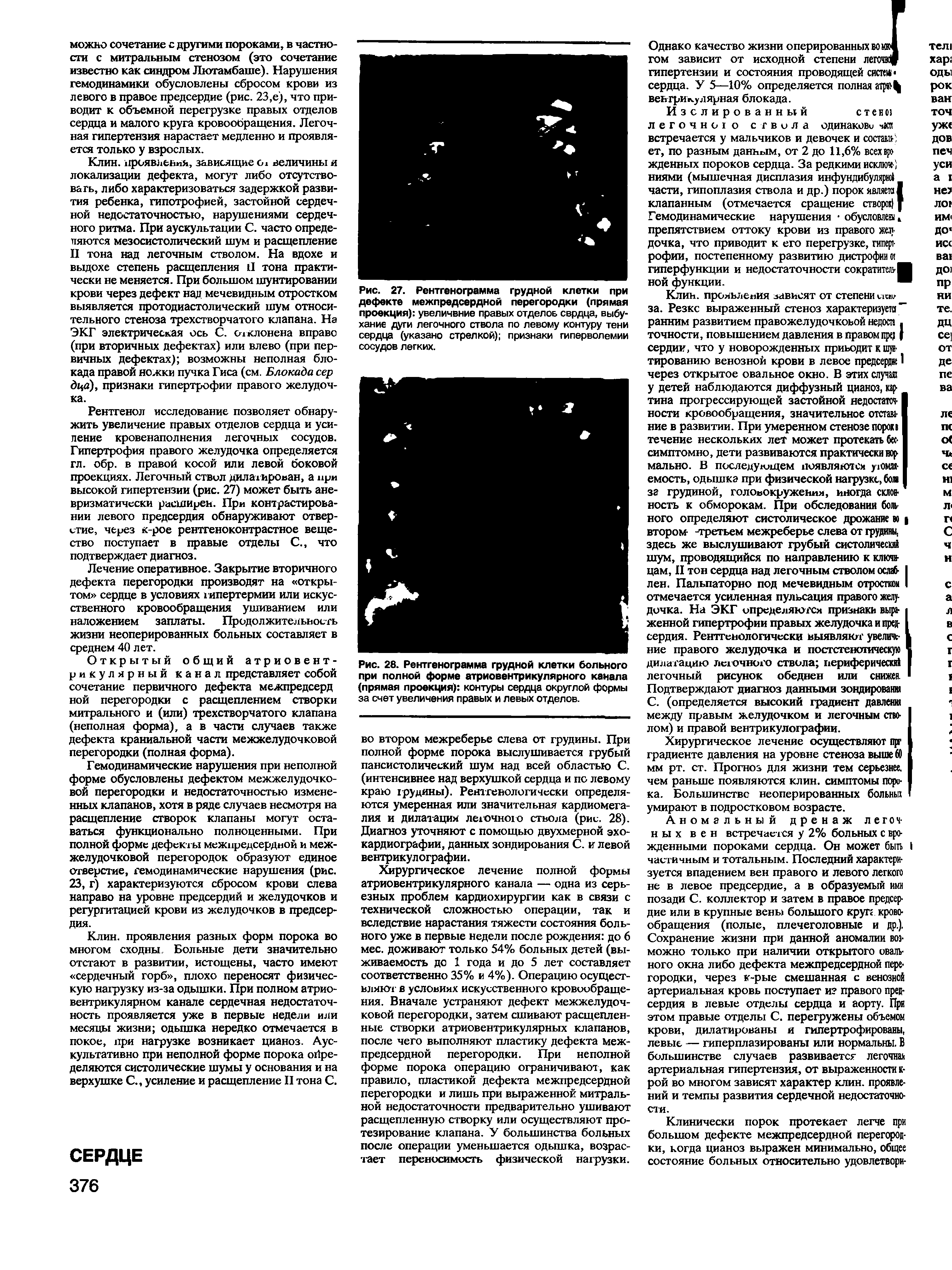 Рис. 28. Рентгенограмма грудной клетки больного при полной форме атриовентрикулярного канала (прямая проекция) контуры сердца округлой формы за счет увеличения правых и левых отделов.