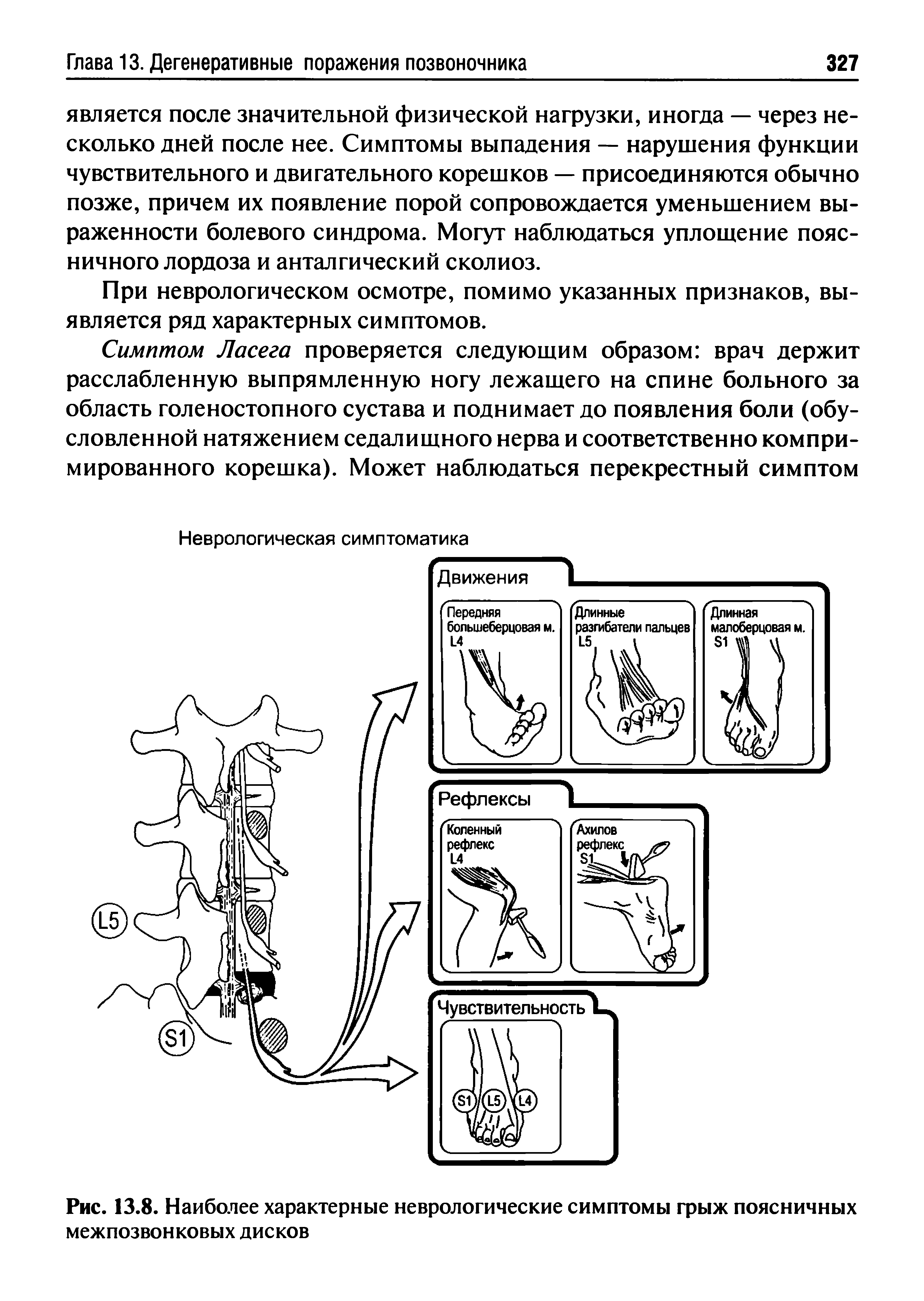 Рис. 13.8. Наиболее характерные неврологические симптомы грыж поясничных межпозвонковых дисков...