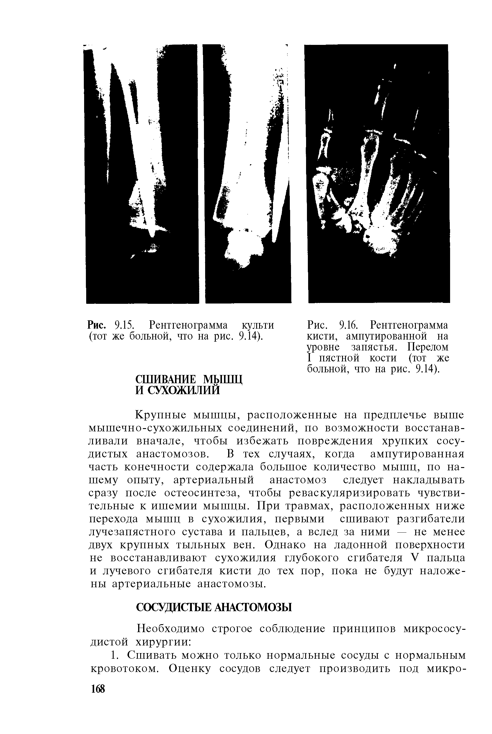 Рис. 9.16. Рентгенограмма кисти, ампутированной на уровне запястья. Перелом I пястной кости (тот же больной, что на рис. 9.14).