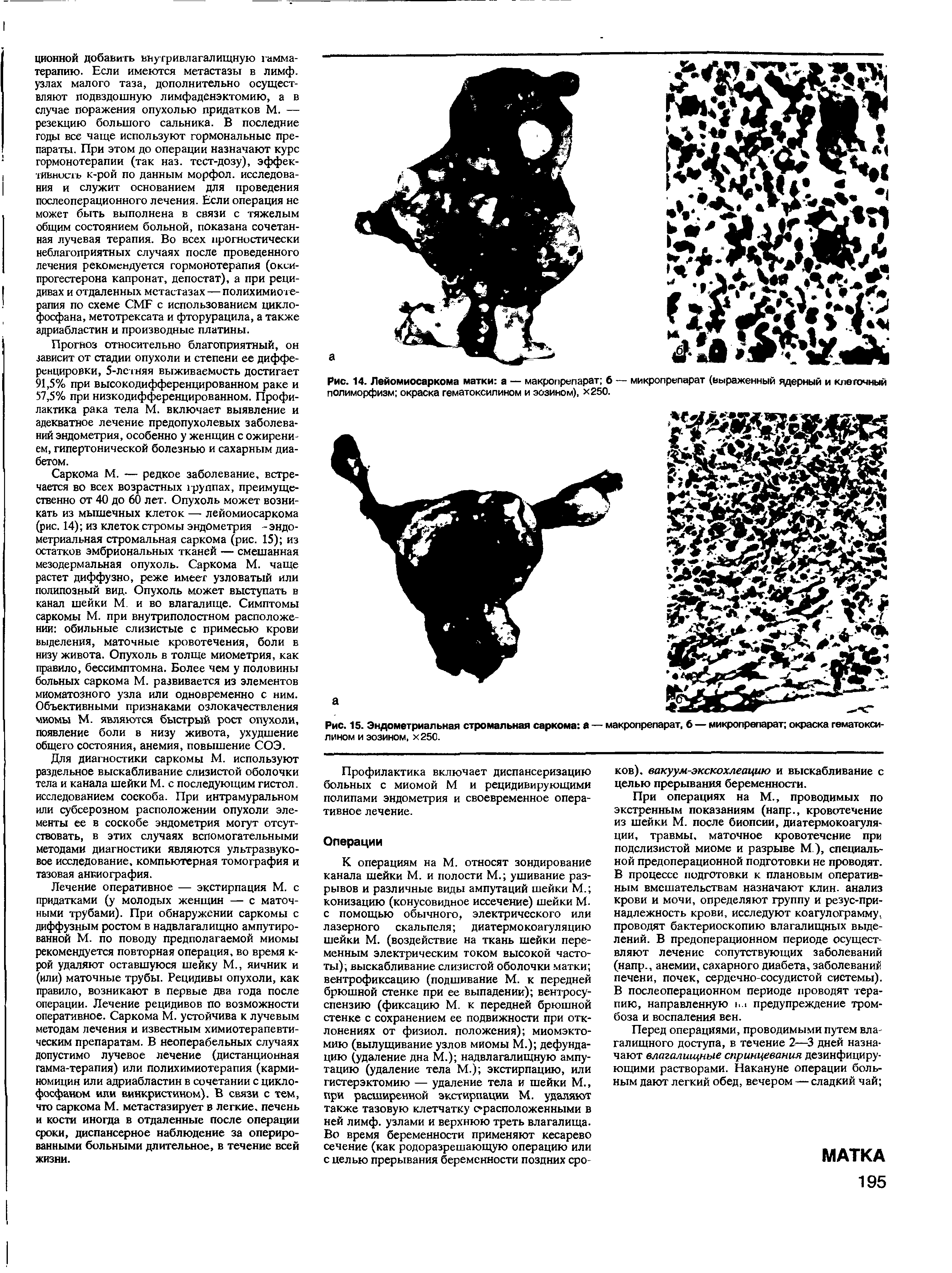 Рис. 14. Лейомиосаркома матки а — макропрепарат б — микропрепарат (выраженный ядерный и клеточный полиморфизм окраска гематоксилином и эозином), х250.