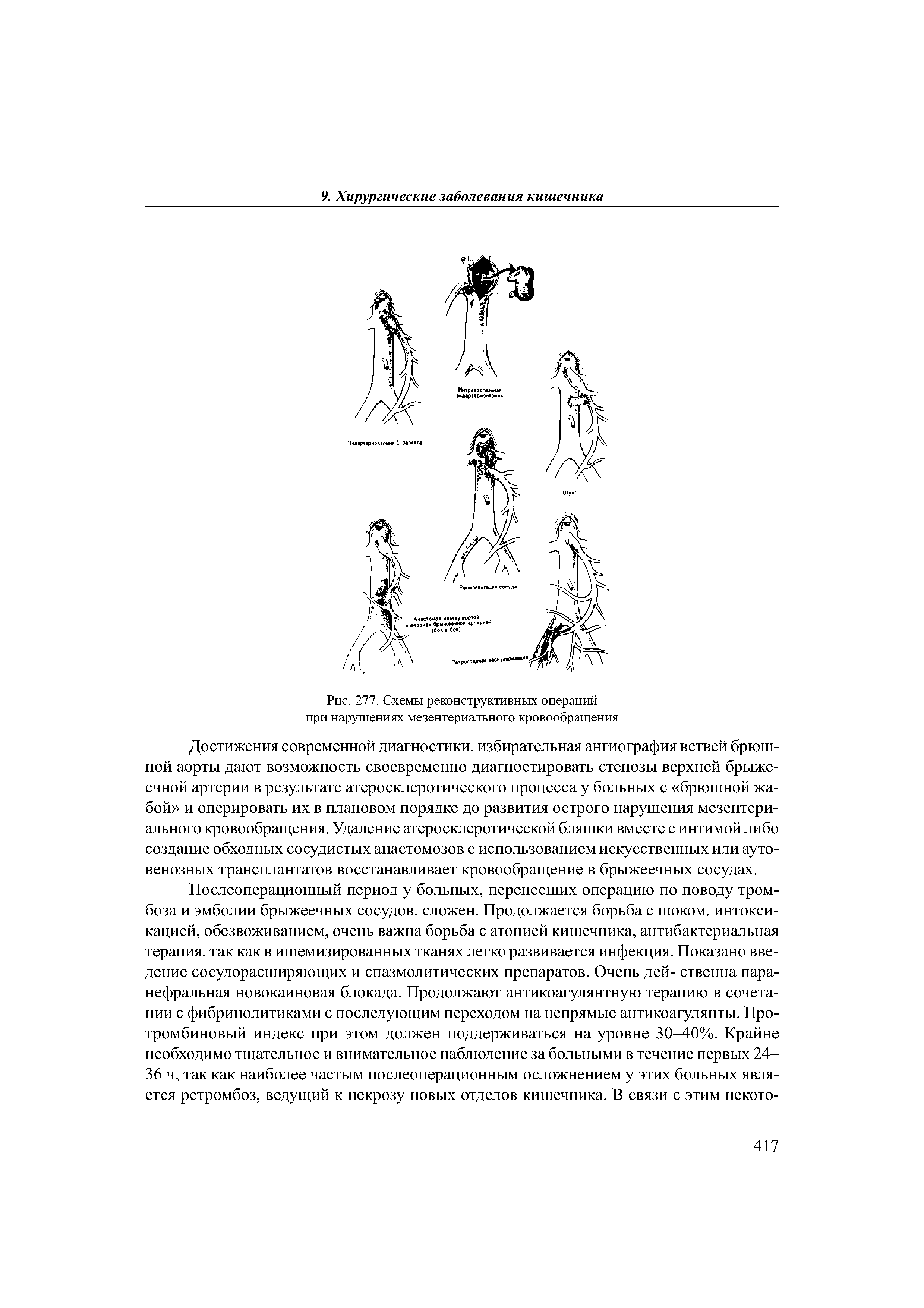 Рис. 277. Схемы реконструктивных операций при нарушениях мезентериального кровообращения...