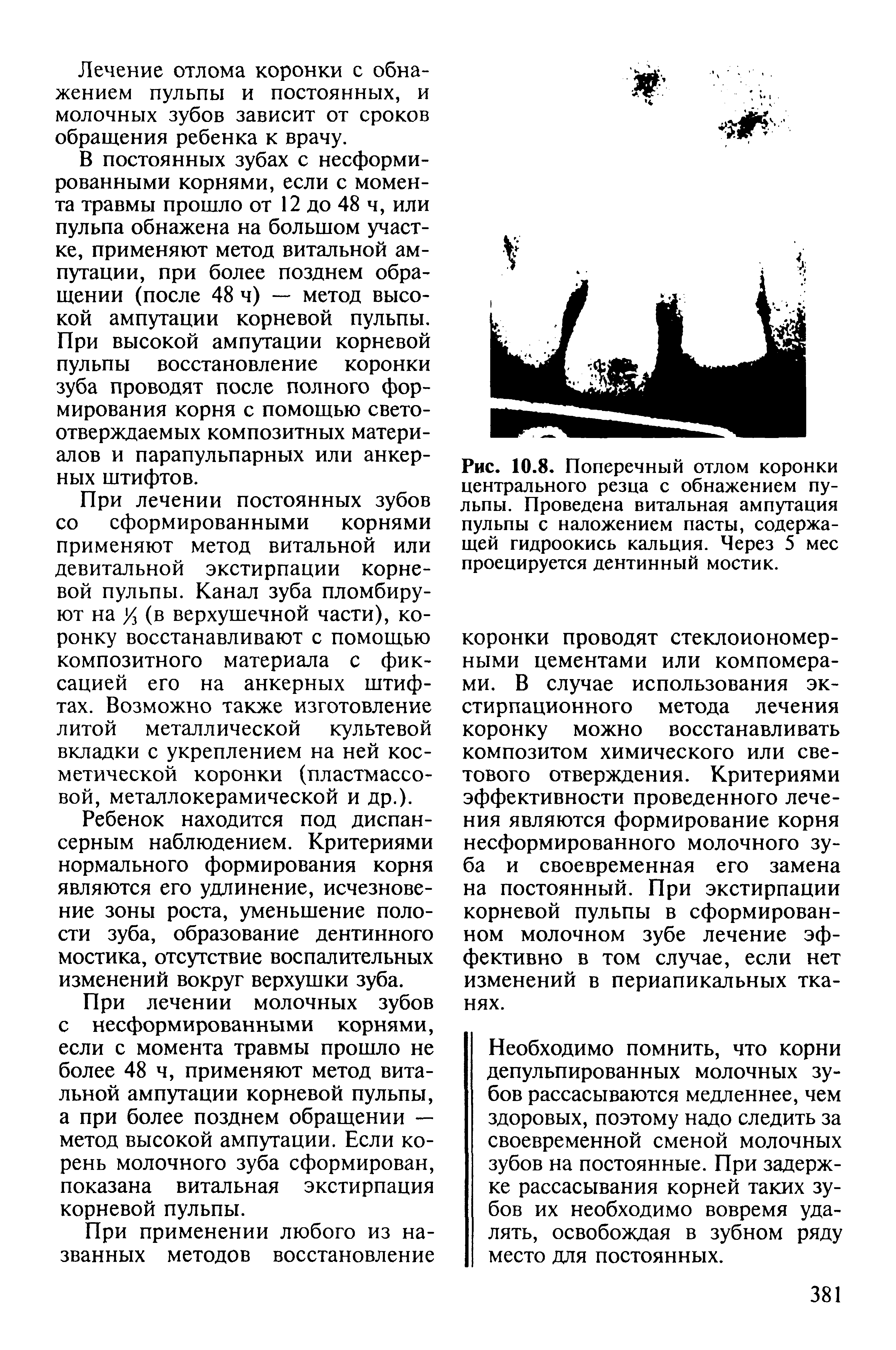 Рис. 10.8. Поперечный отлом коронки центрального резца с обнажением пульпы. Проведена витальная ампутация пульпы с наложением пасты, содержащей гидроокись кальция. Через 5 мес проецируется дентинный мостик.