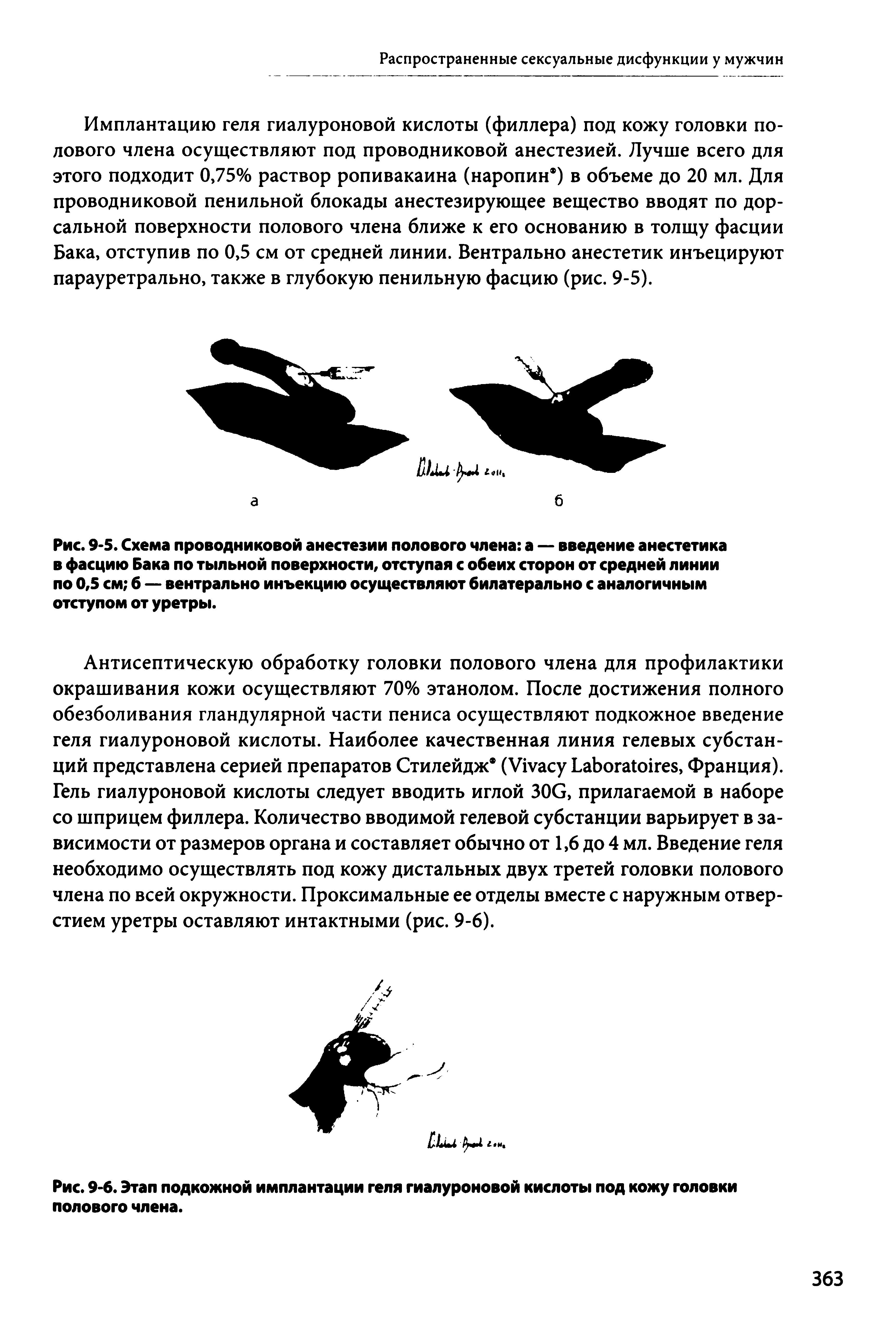 Рис. 9-5. Схема проводниковой анестезии полового члена а — введение анестетика в фасцию Бака по тыльной поверхности, отступая с обеих сторон от средней линии по 0,5 см б — вентрально инъекцию осуществляют билатерально с аналогичным отступом от уретры.