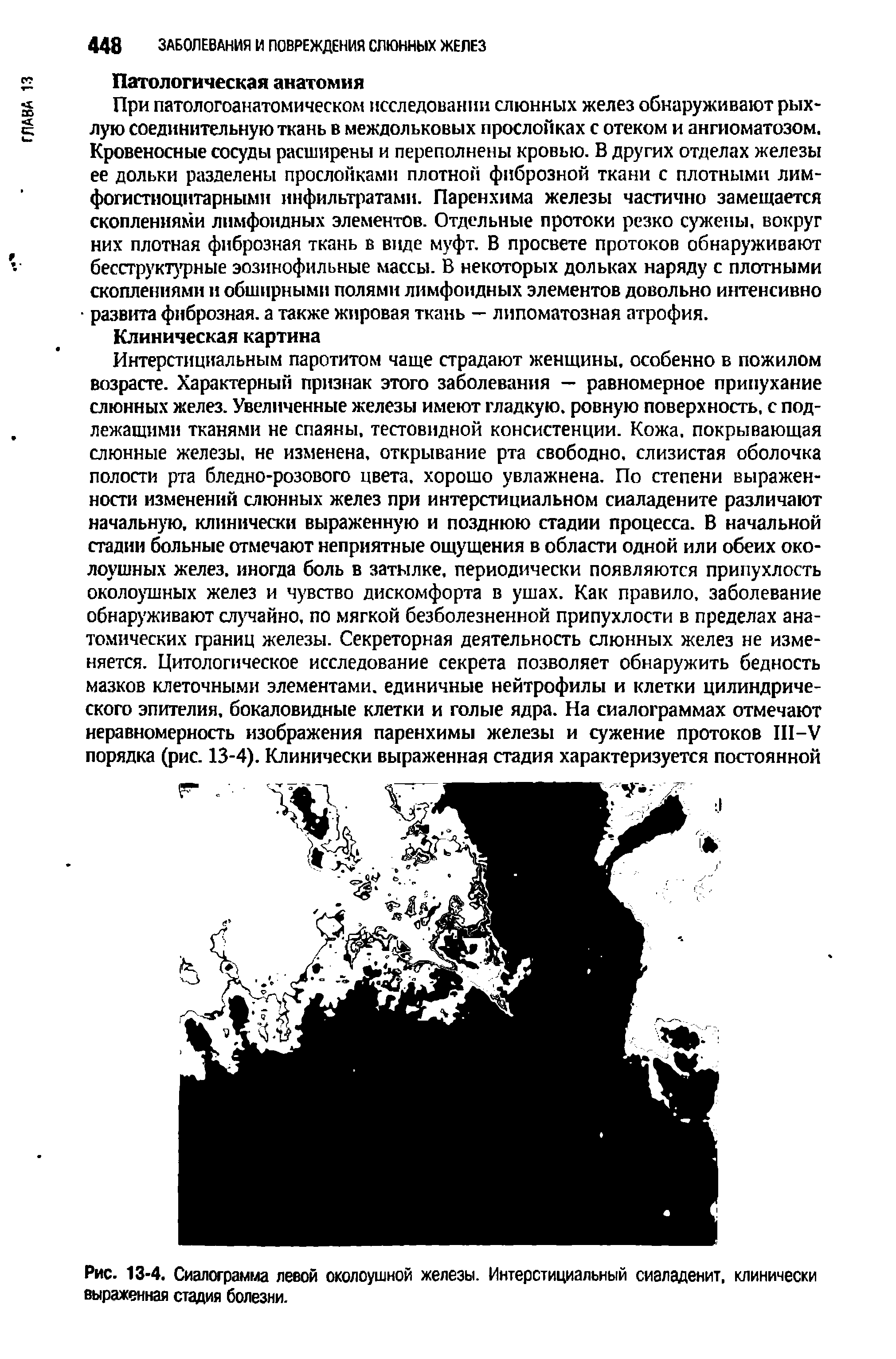 Рис. 13-4. Сиалограмма левой околоушной железы. Интерстициальный сиаладенит, клинически выраженная стадия болезни.