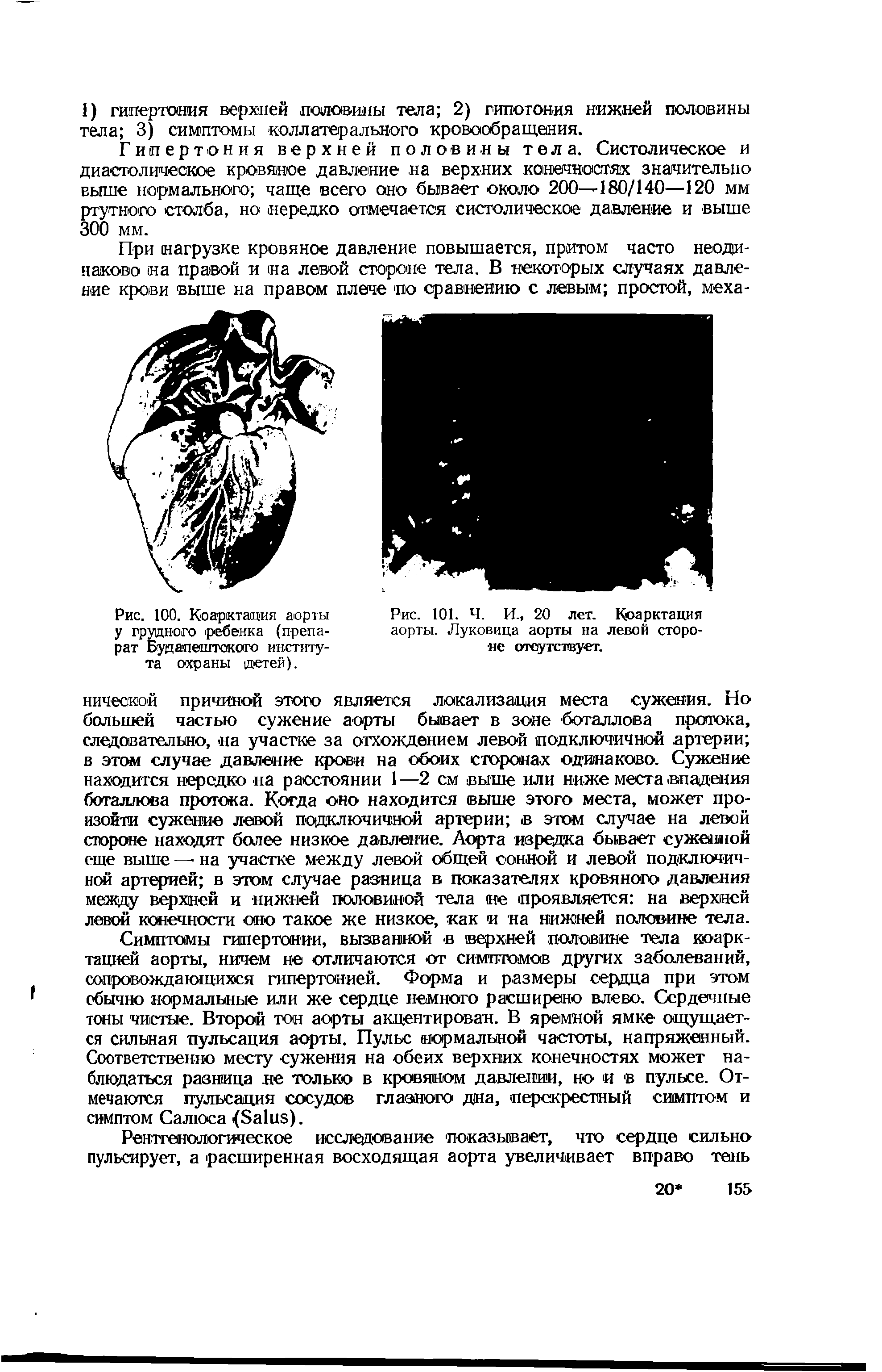 Рис. 101. Ч. И., 20 лет. Коарктация аорты. Луковица аорты на левой стороне отсутствует.