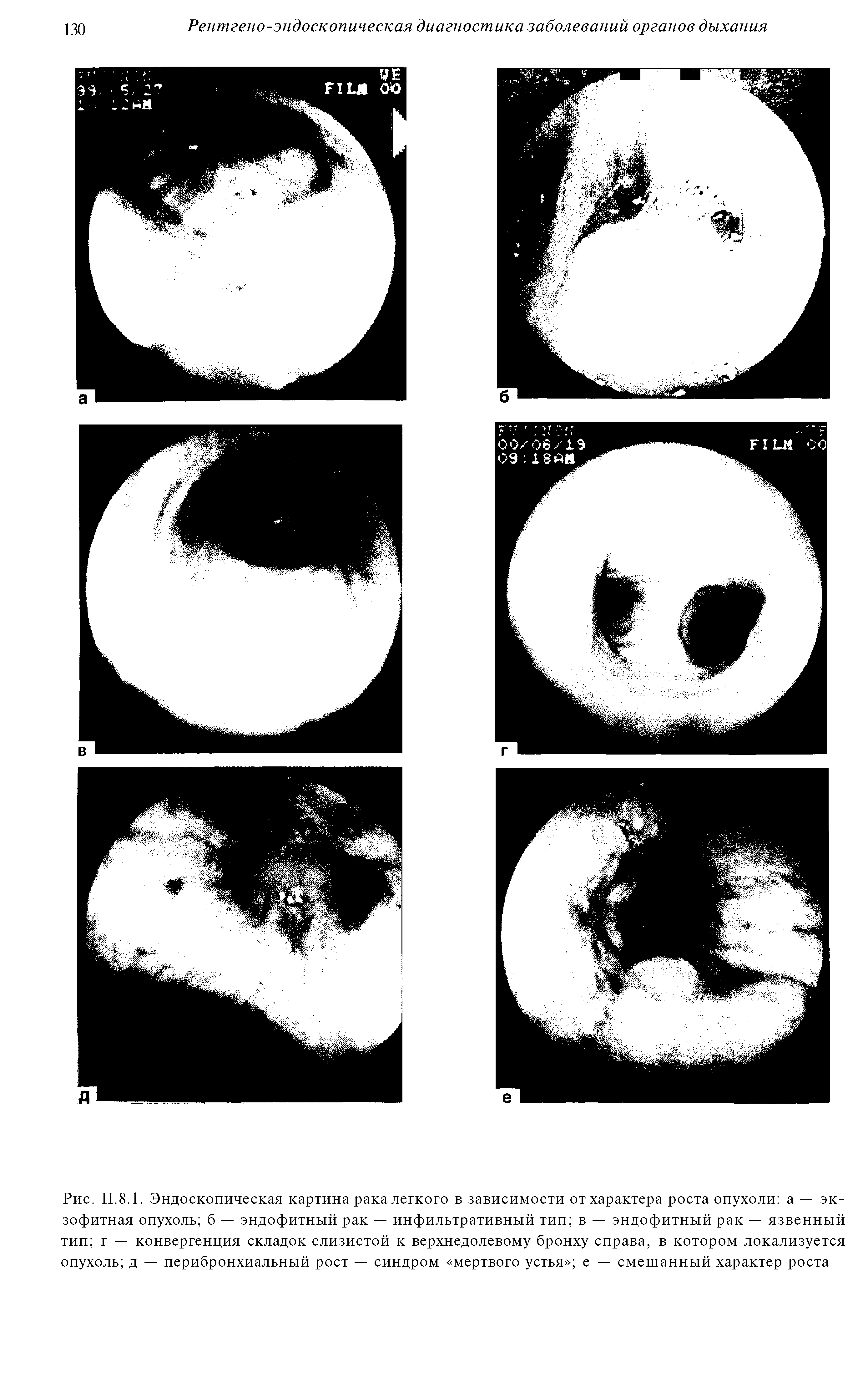 Рис. II.8.1. Эндоскопическая картина рака легкого в зависимости от характера роста опухоли а — экзофитная опухоль б — эндофитный рак — инфильтративный тип в — эндофитный рак — язвенный тип г — конвергенция складок слизистой к верхнедолевому бронху справа, в котором локализуется опухоль д — перибронхиальный рост — синдром мертвого устья е — смешанный характер роста...