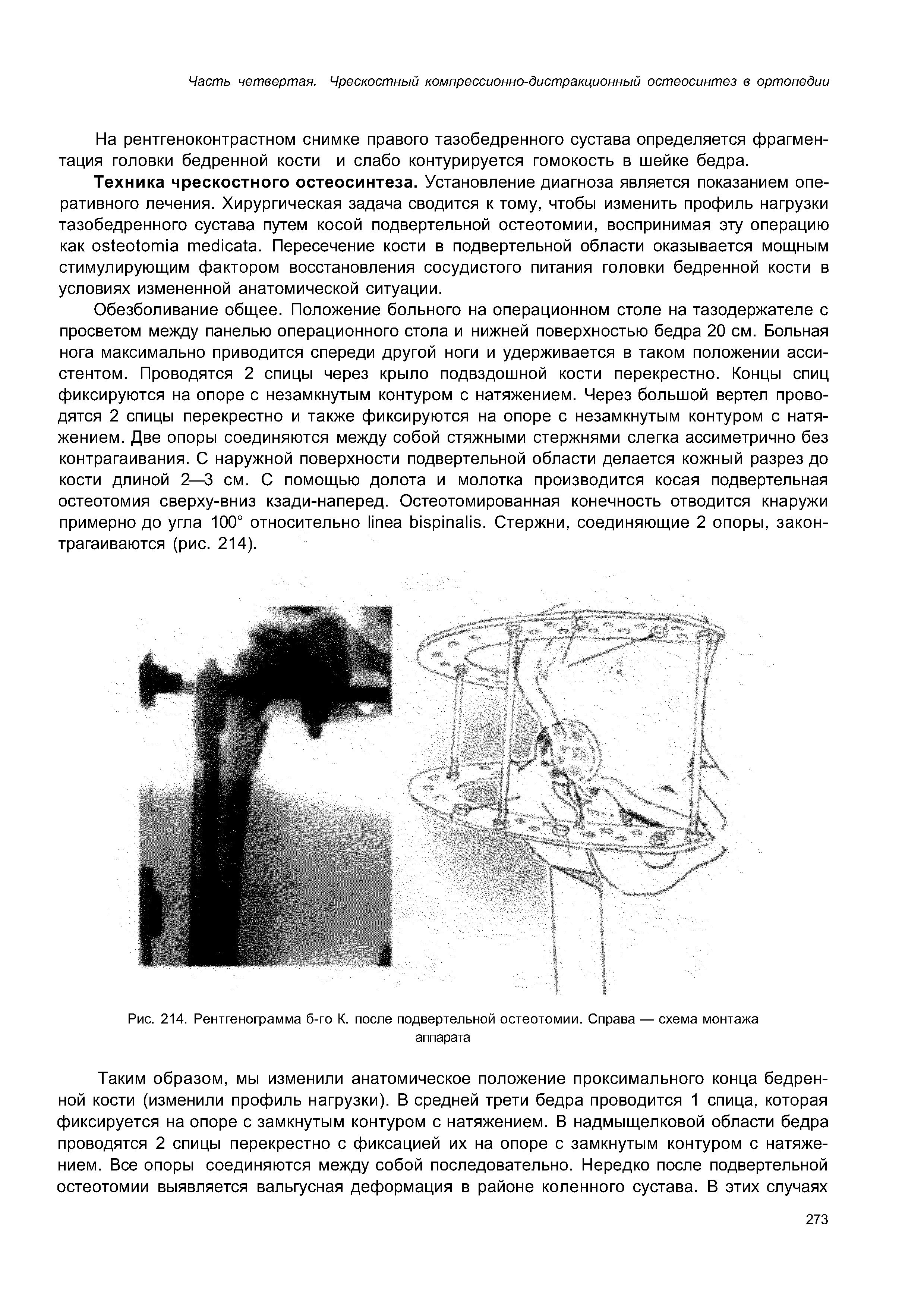 Рис. 214. Рентгенограмма б-го К. после подвертельной остеотомии. Справа — схема монтажа аппарата...