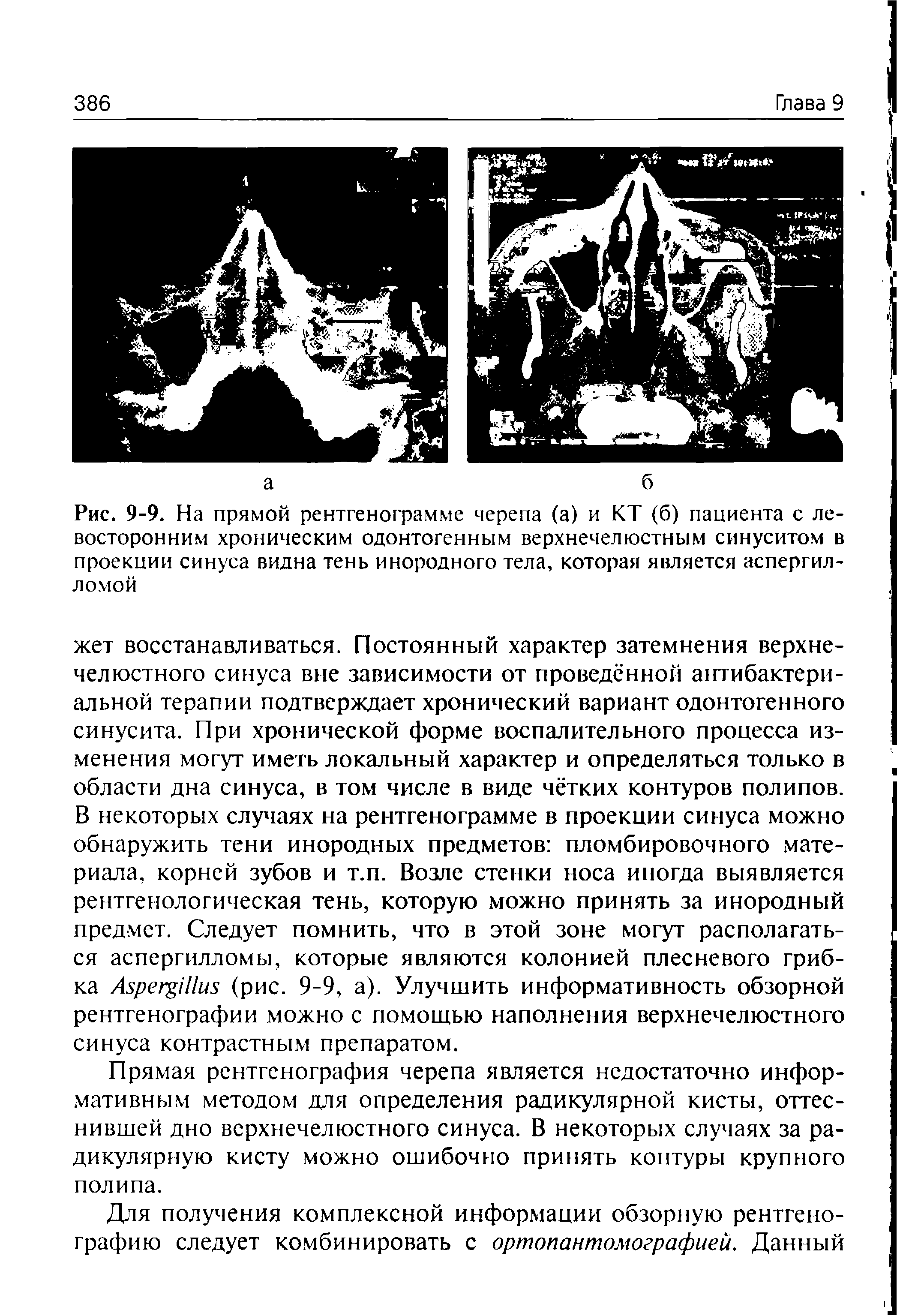 Рис. 9-9. На прямой рентгенограмме черепа (а) и КТ (б) пациента с левосторонним хроническим одонтогенным верхнечелюстным синуситом в проекции синуса видна тень инородного тела, которая является аспергил-ломой...