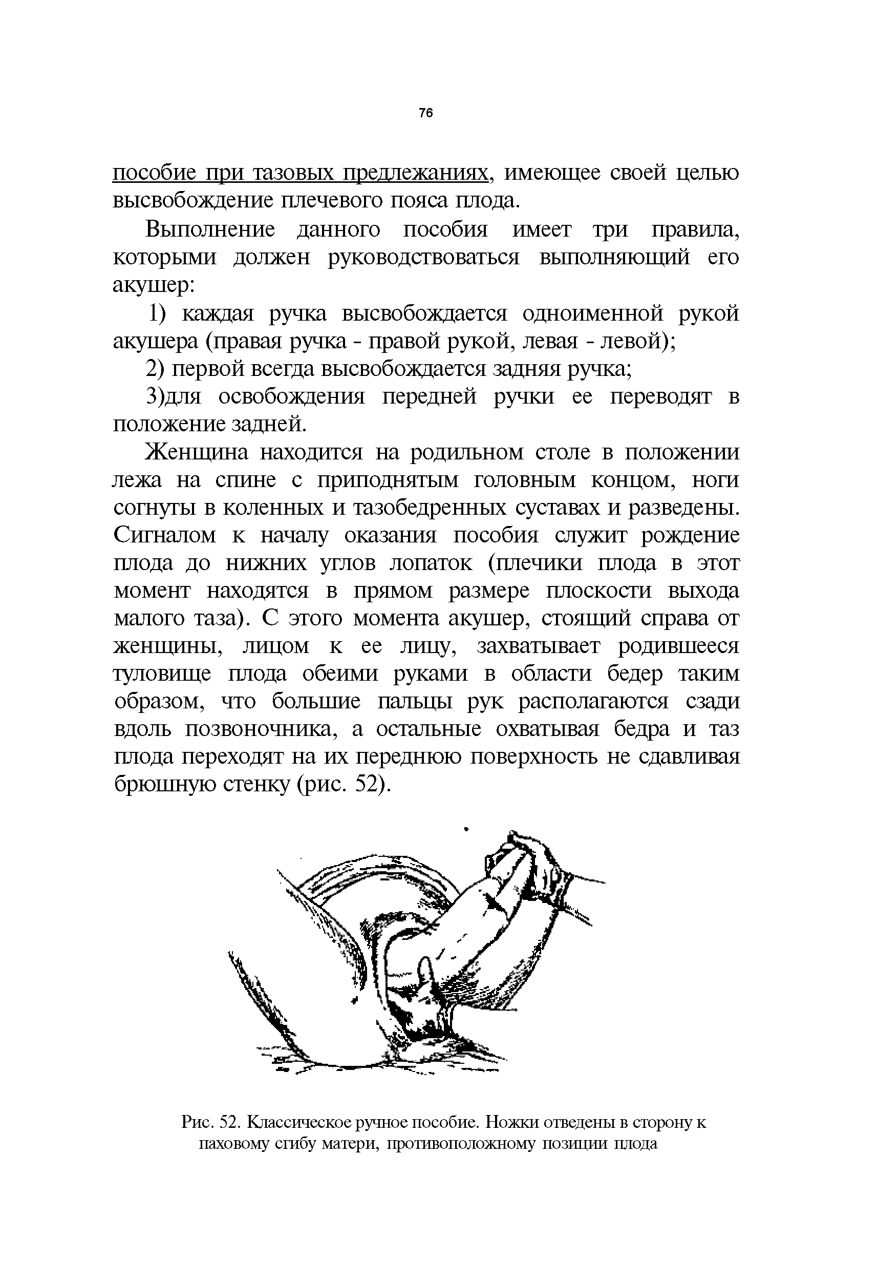 Рис. 52. Классическое ручное пособие. Ножки отведены в сторону к паховому сгибу матери, противоположному позиции плода...