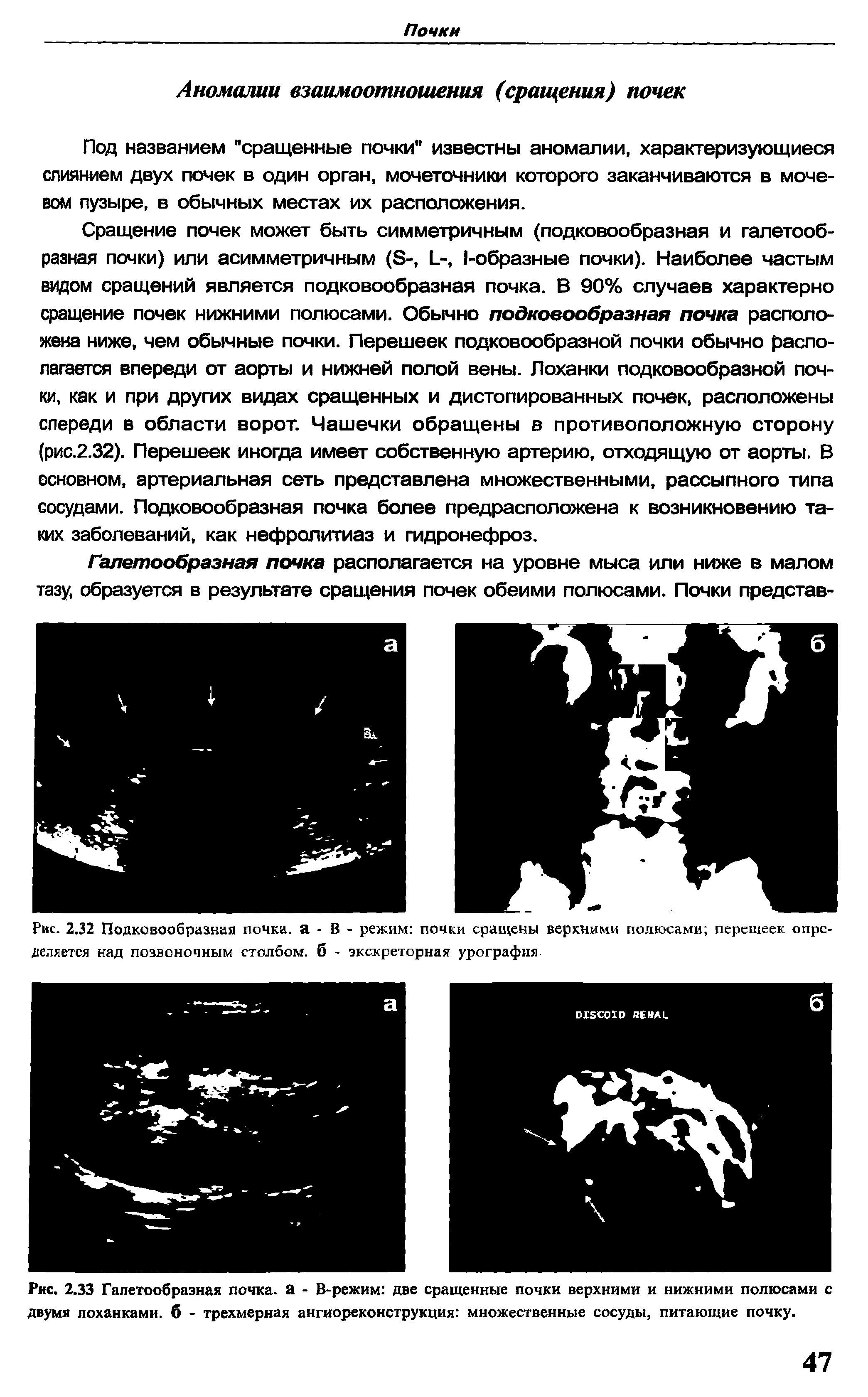 Рис. 2.33 Галетообразная почка, а - В-режим две сращенные почки верхними и нижними полюсами с двумя лоханками, б - трехмерная ангиореконструкция множественные сосуды, питающие почку.