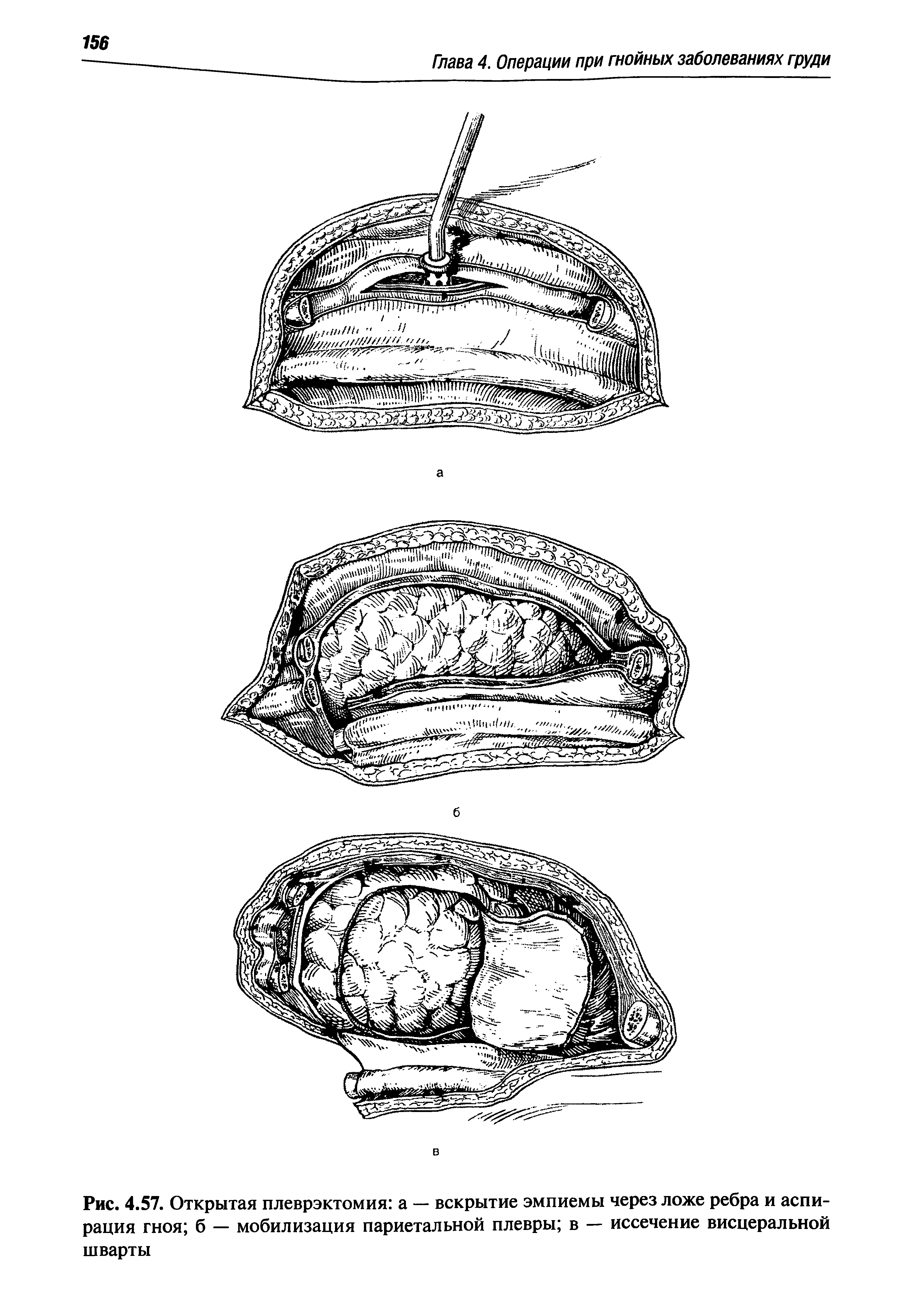 Рис. 4.57. Открытая плеврэктомия а — вскрытие эмпиемы через ложе ребра и аспирация гноя б — мобилизация париетальной плевры в — иссечение висцеральной шварты...
