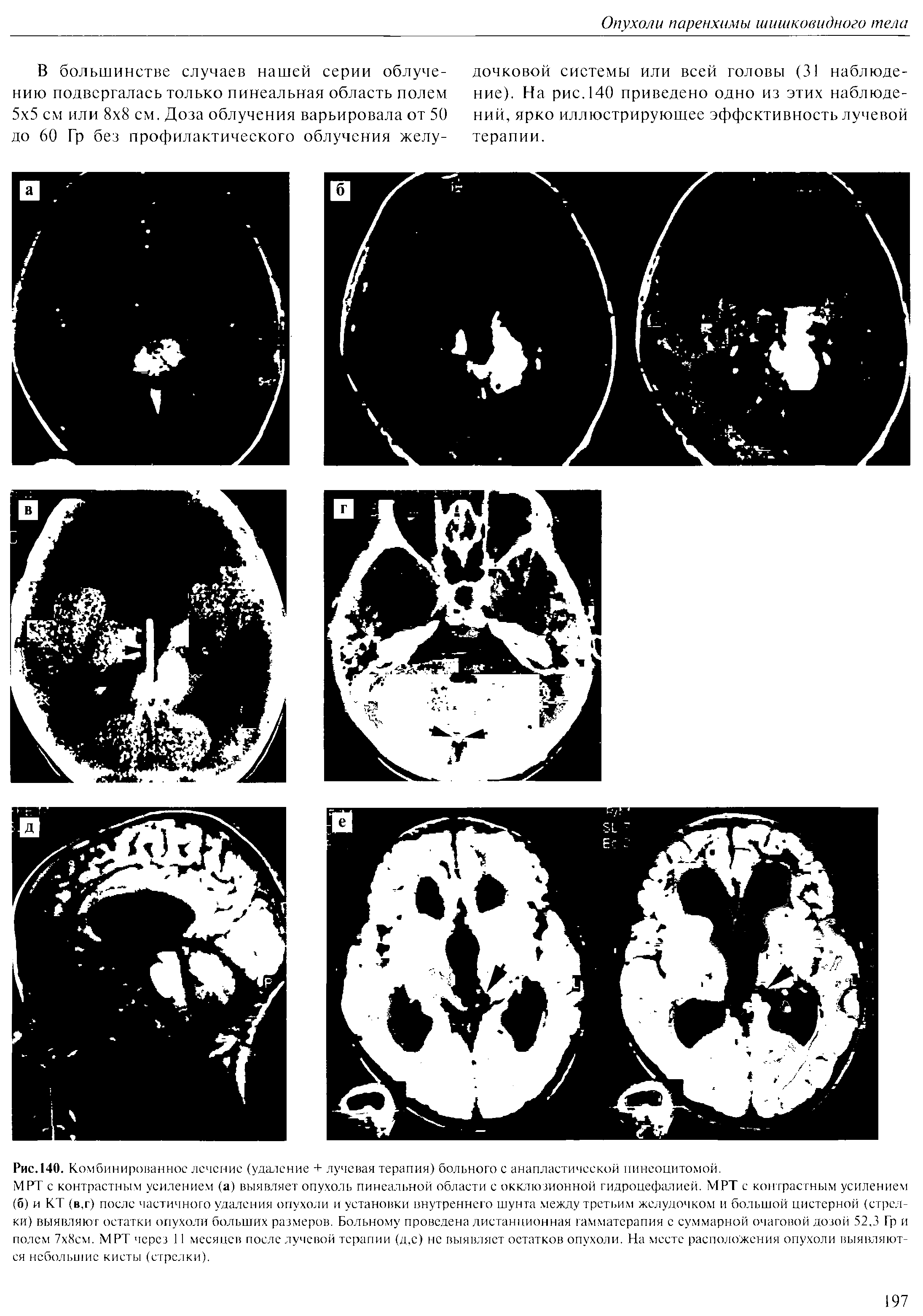 Рис. 140. Ком бинированнос лечение (удаление + лучевая терапия) больного с анапластической пинеоцитомой.