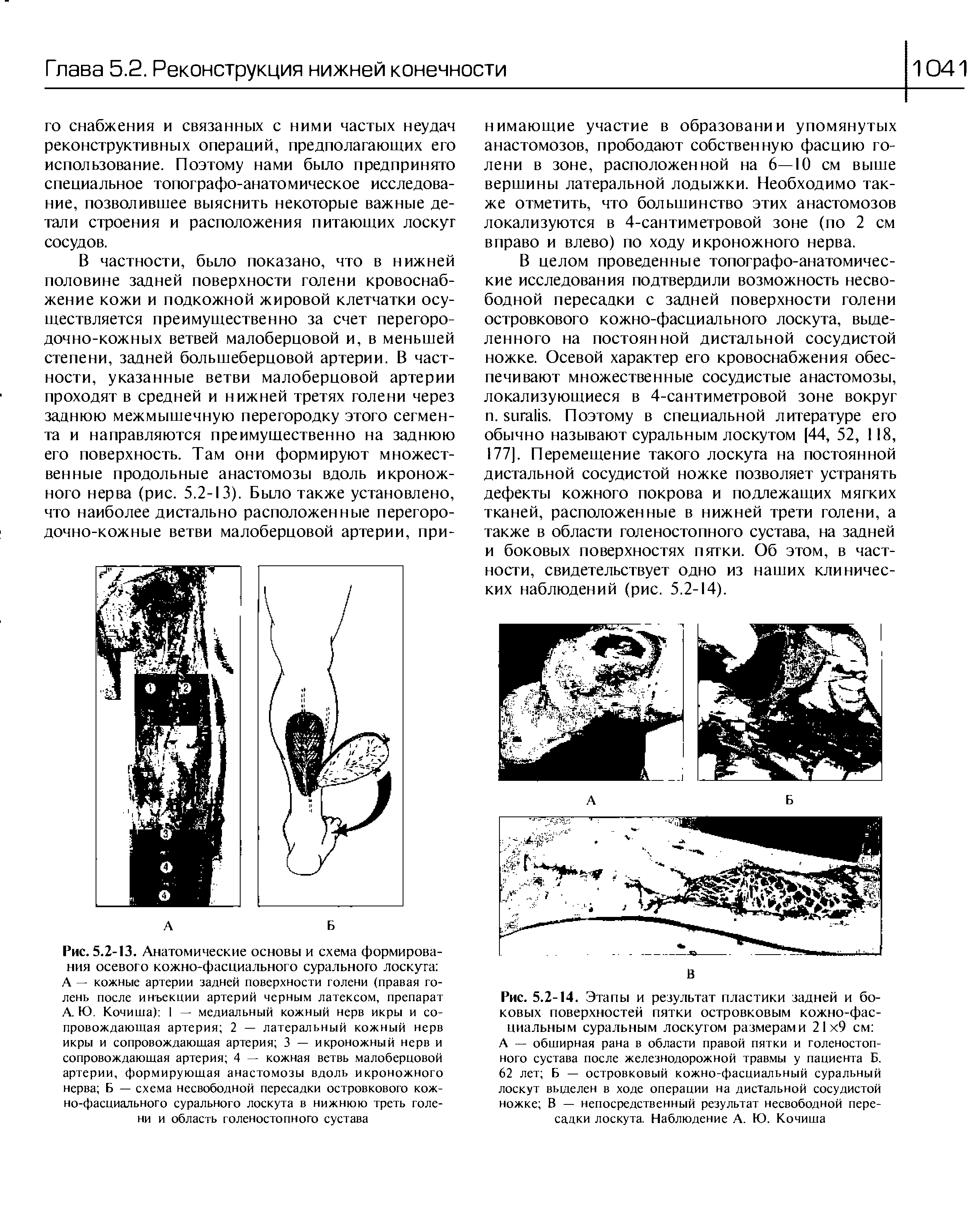 Рис. 5.2-14. Этапы и результат пластики задней и боковых поверхностей пятки островковым кожно-фасциальным суральным лоскутом размерами 21 9 см ...